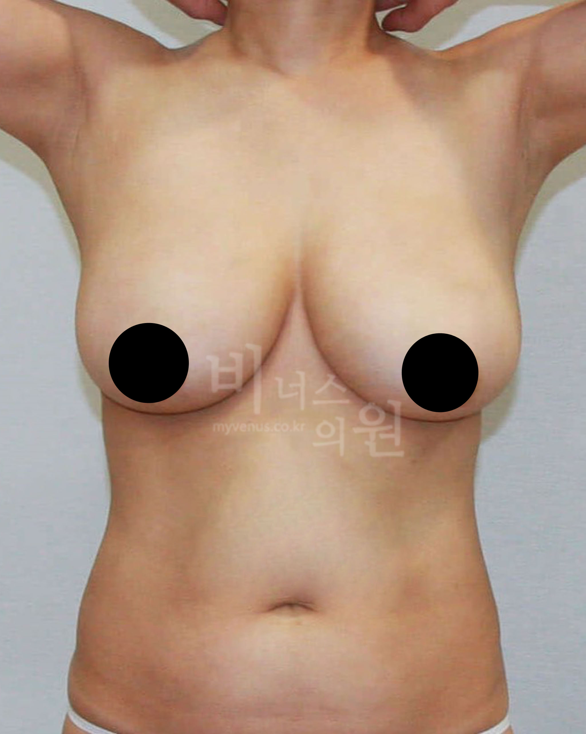 거대유방 지방흡입.jpg