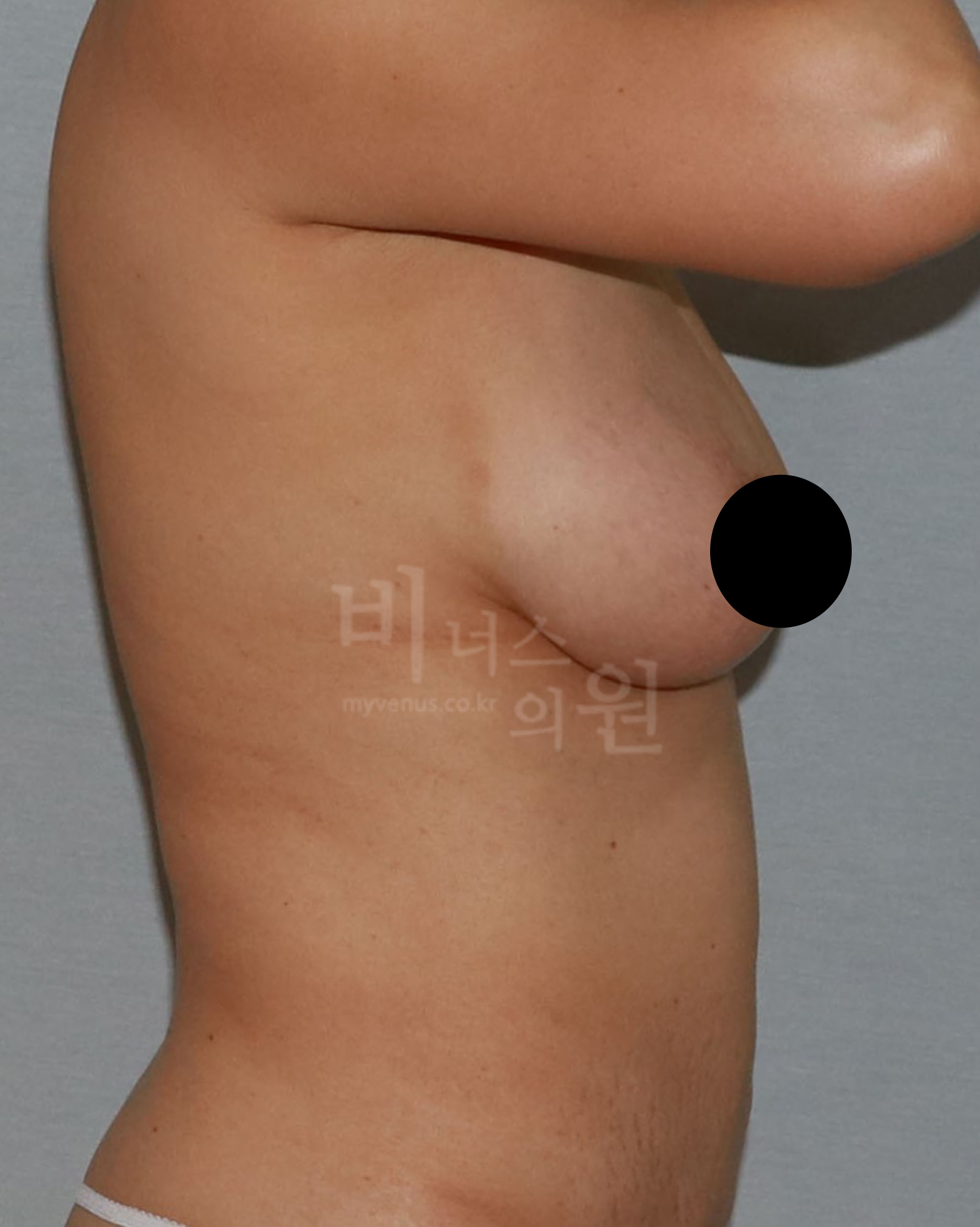 가슴 지방흡입.jpg