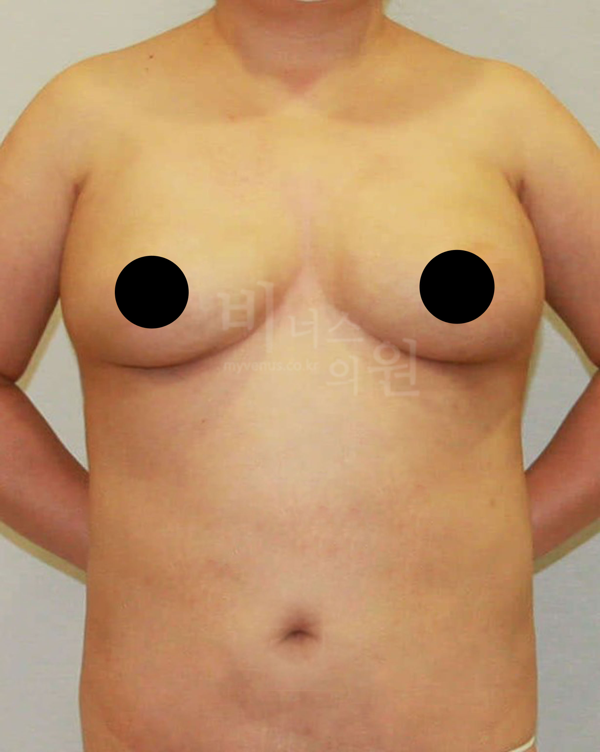 유방지방흡입.jpg