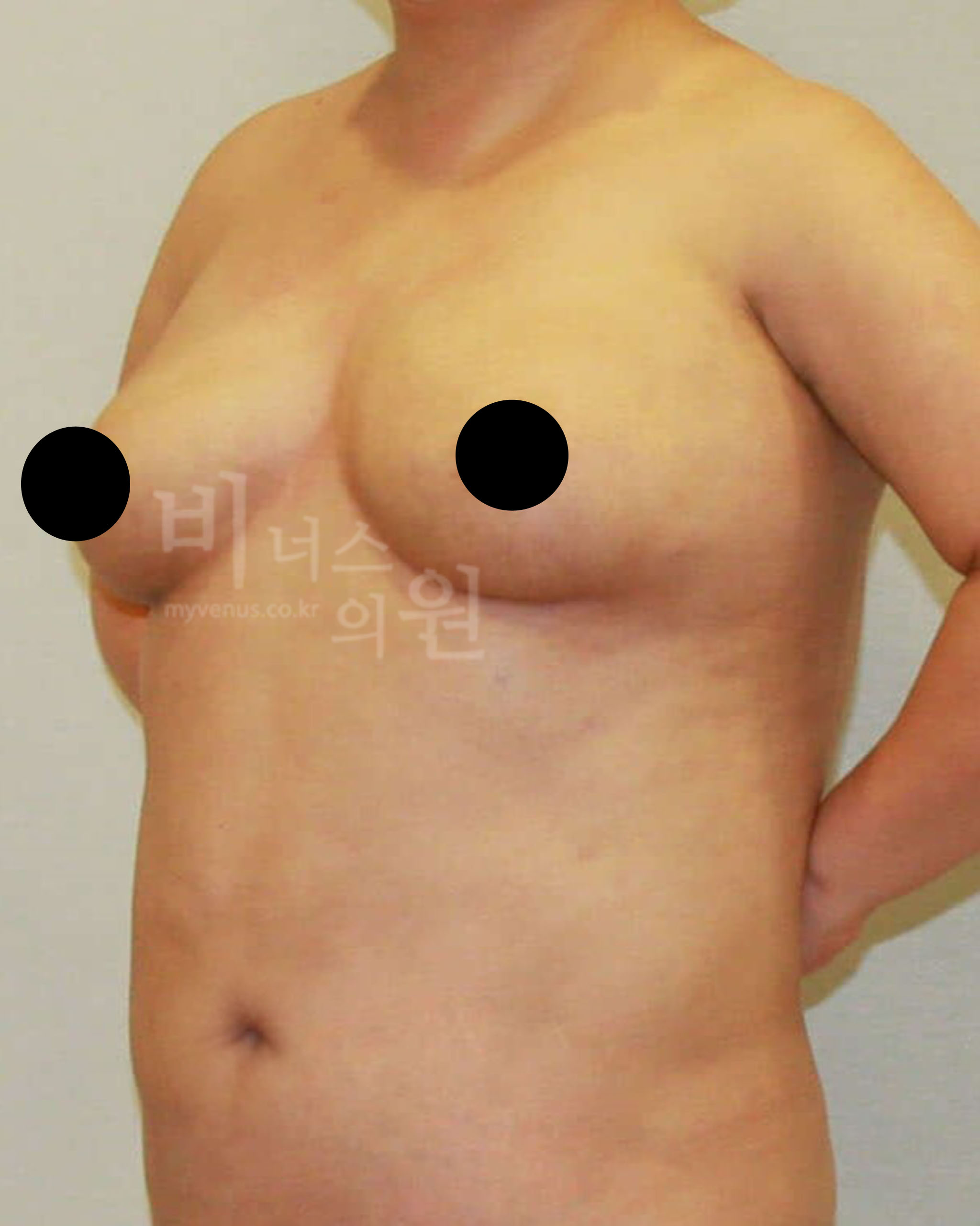 가슴 지방흡입.jpg