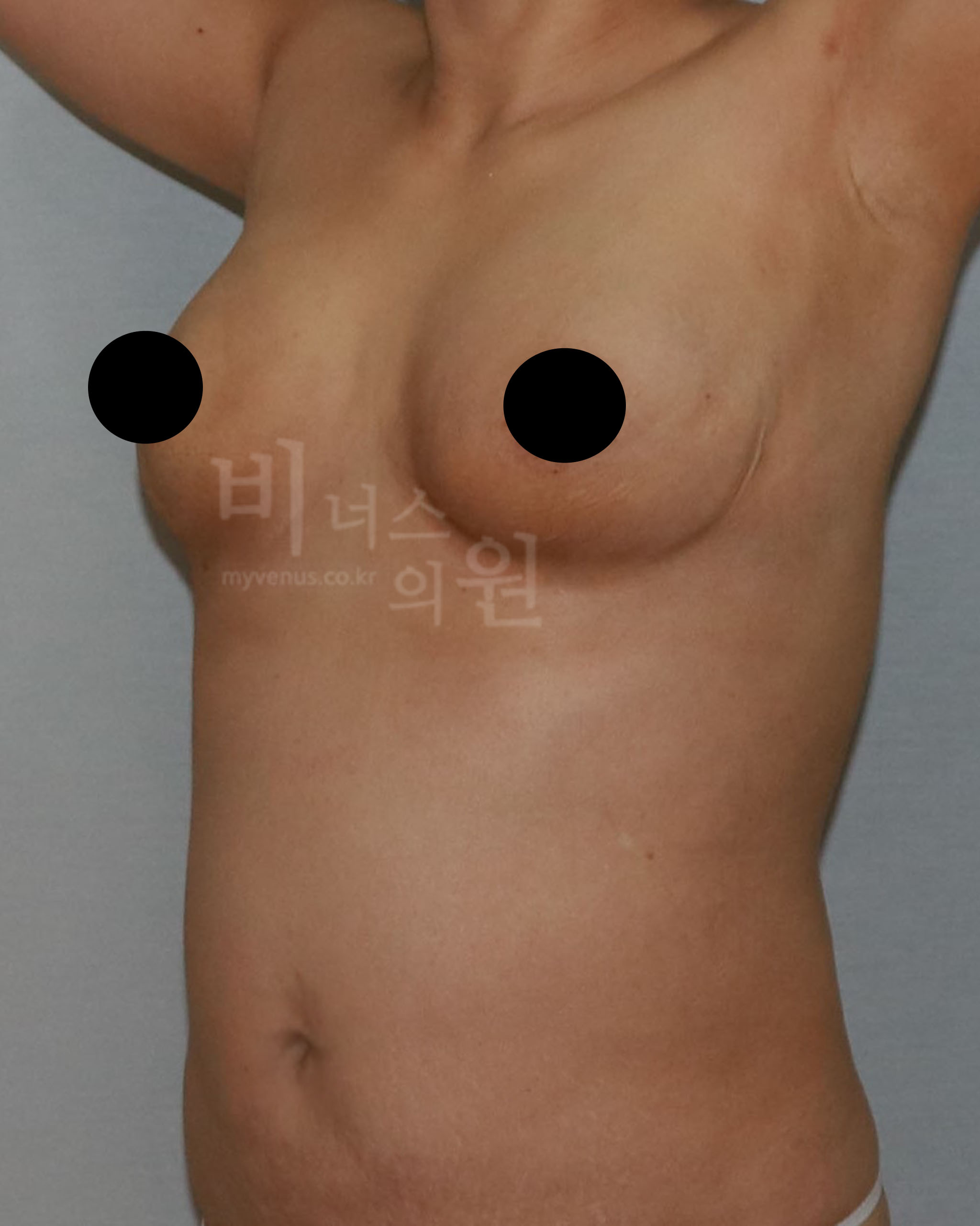 처진 가슴 리프팅.jpg