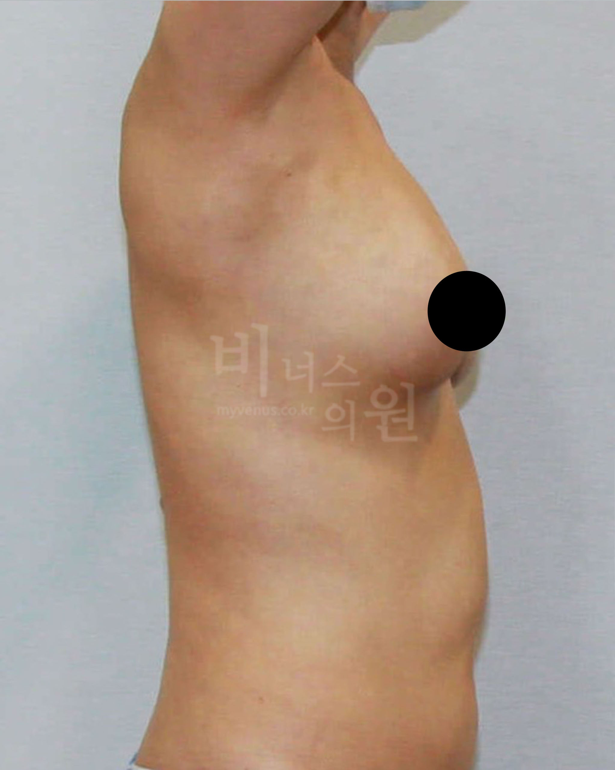 부유방 지방흡입.jpg