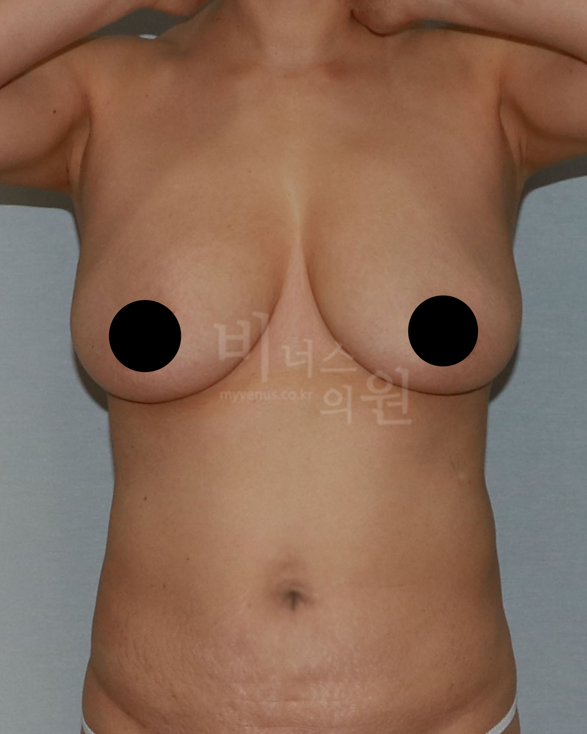 유방지방흡입.jpg