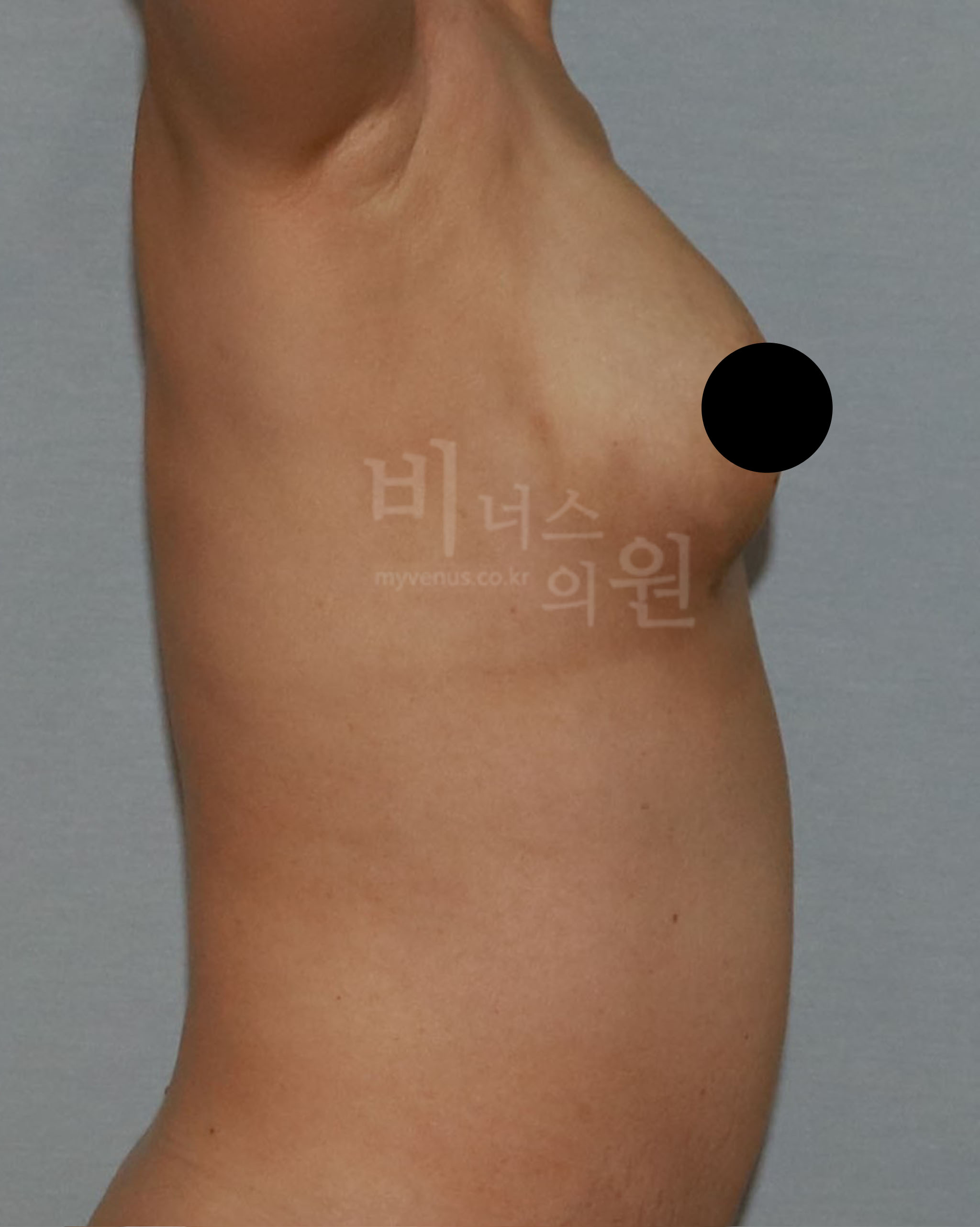 가슴 지방흡입.jpg