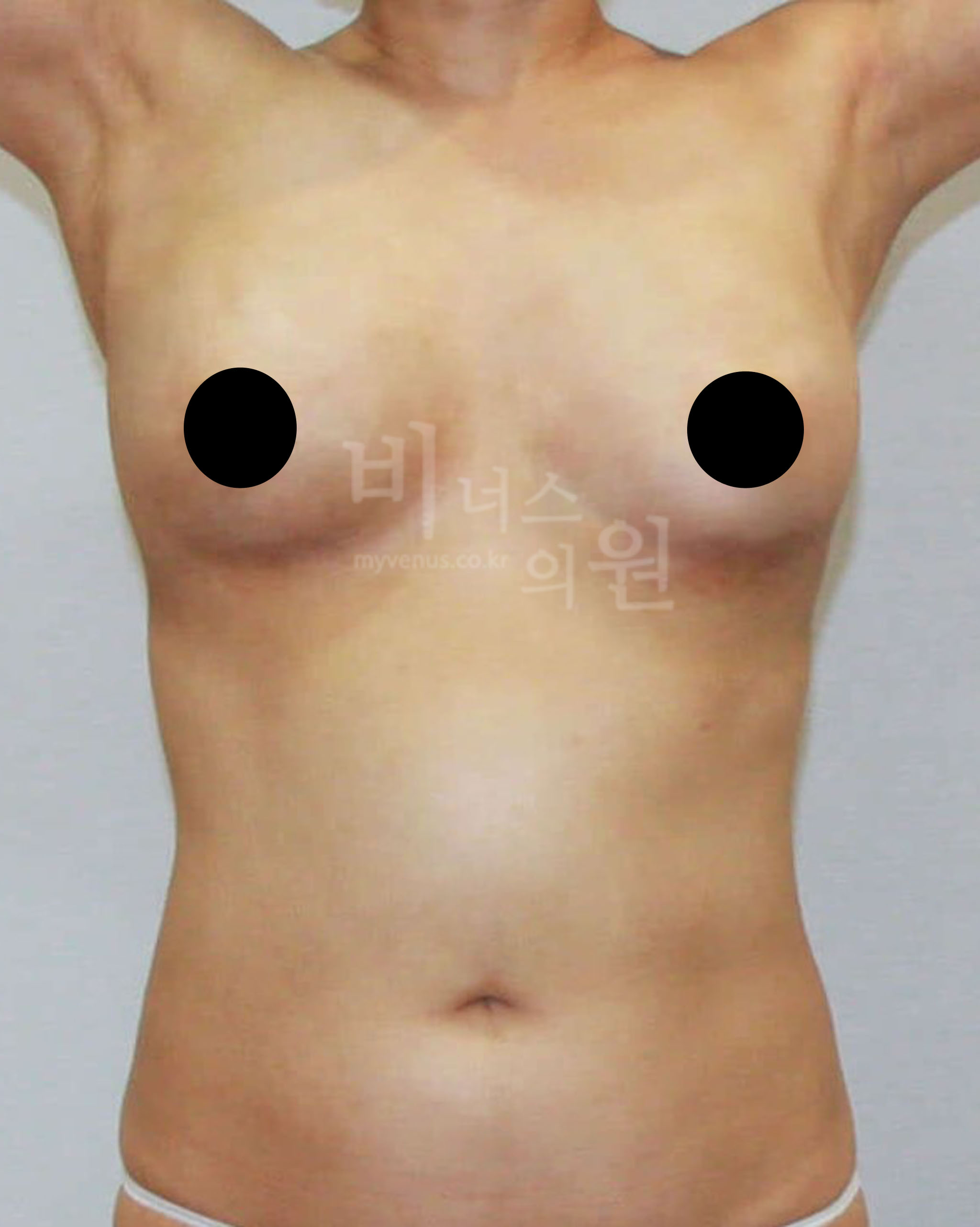 가슴 리프팅.jpg