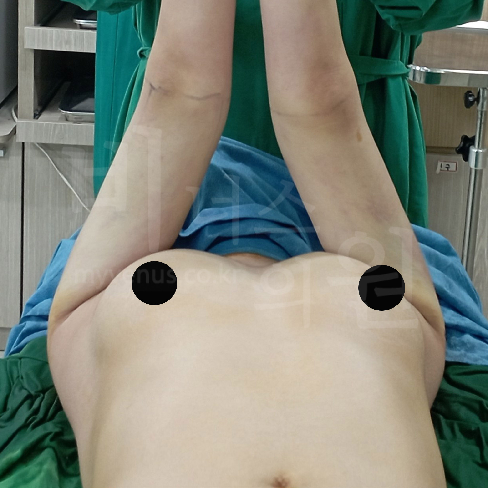 지방흡입 효과.jpg