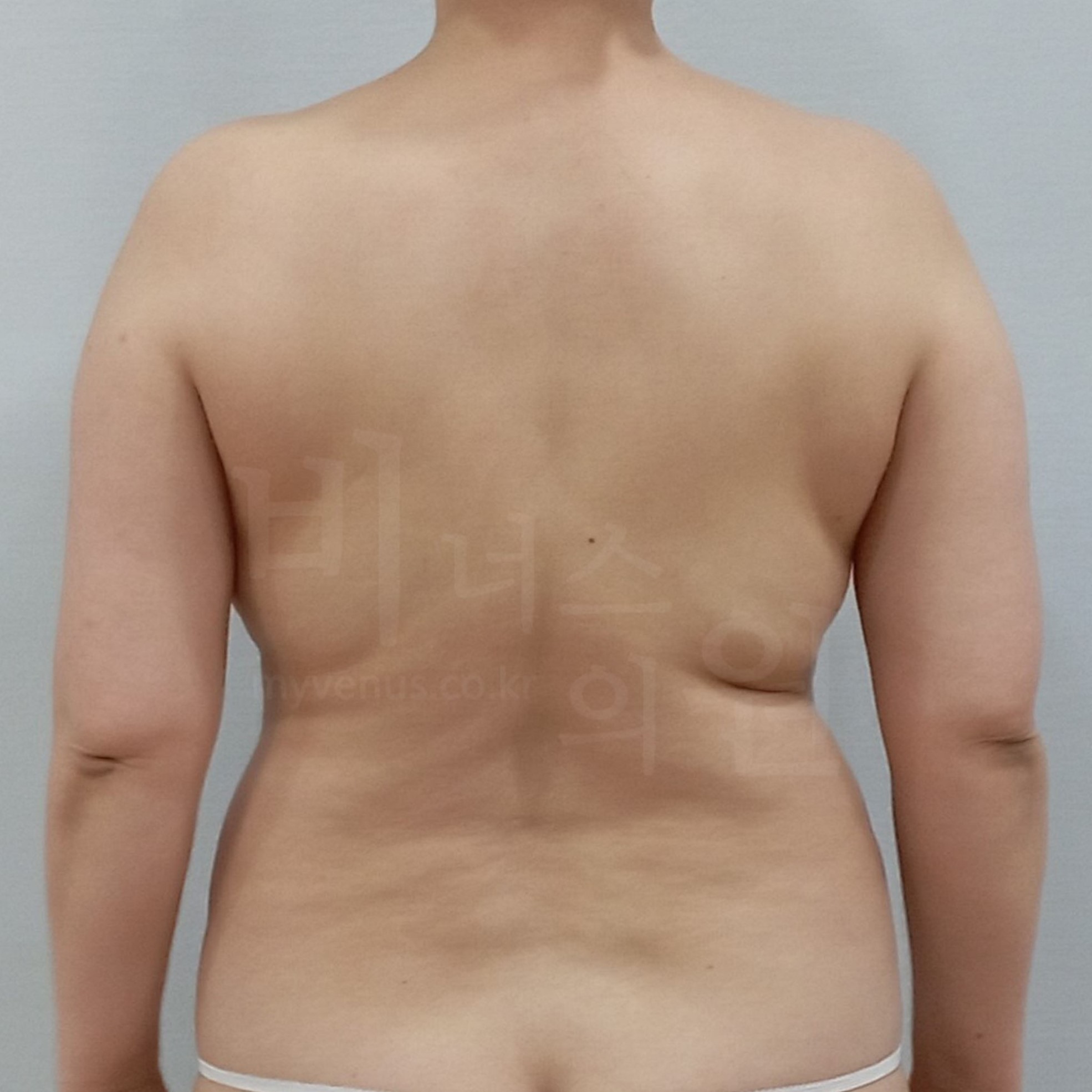 두껍고 불균형한 팔 뒤 라인.jpg