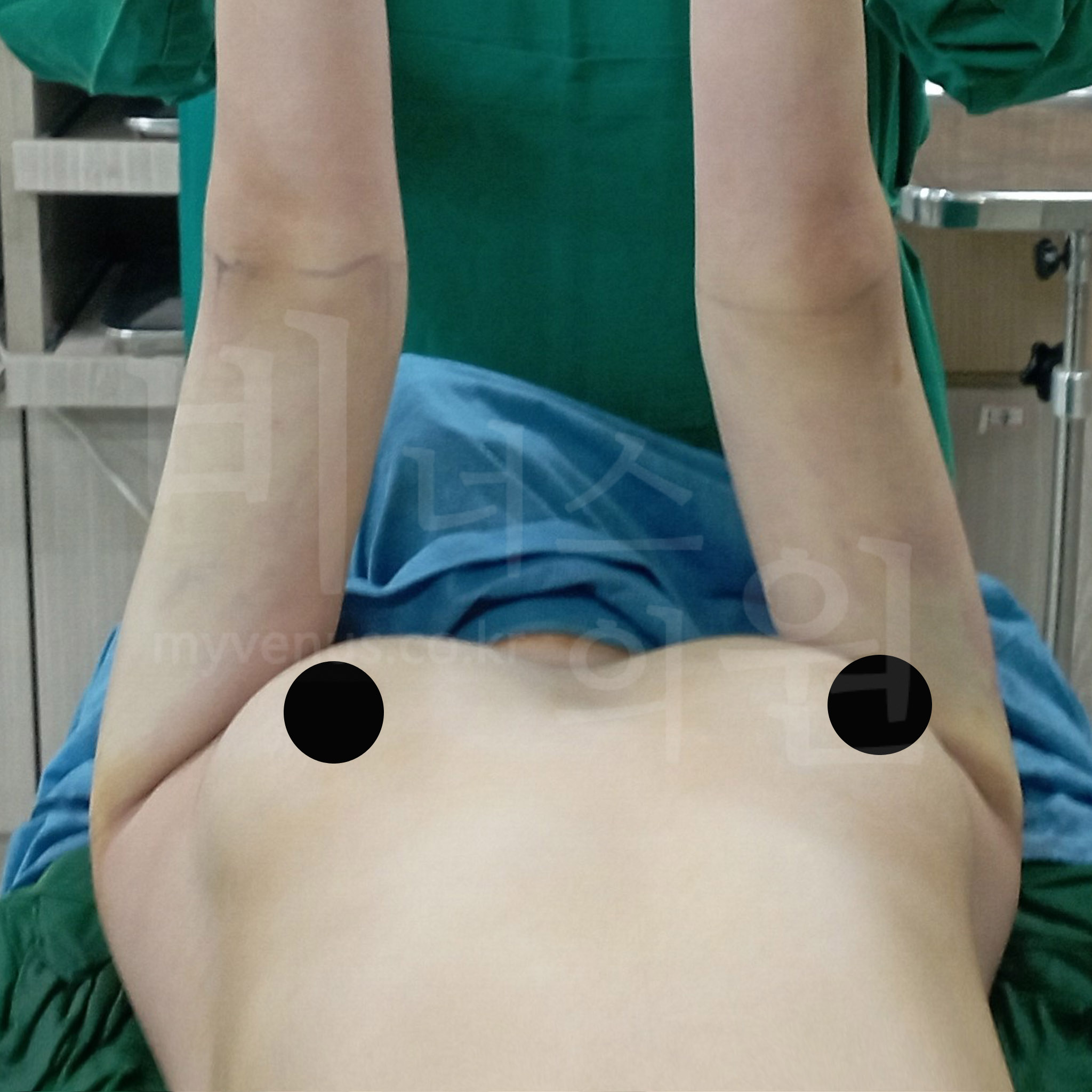 지방흡입 변화.jpg