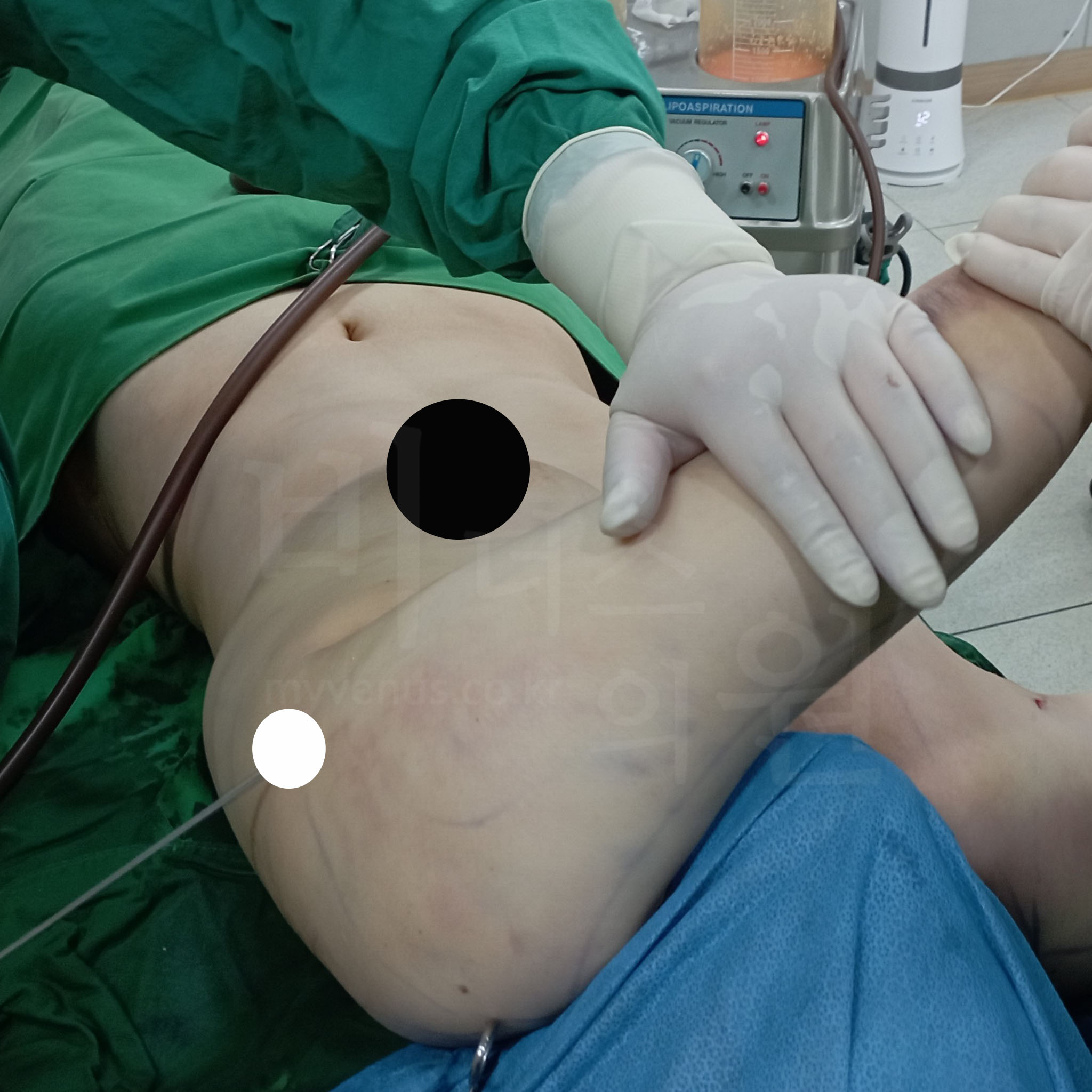 팔뚝 지방흡입  수술 방법.jpg