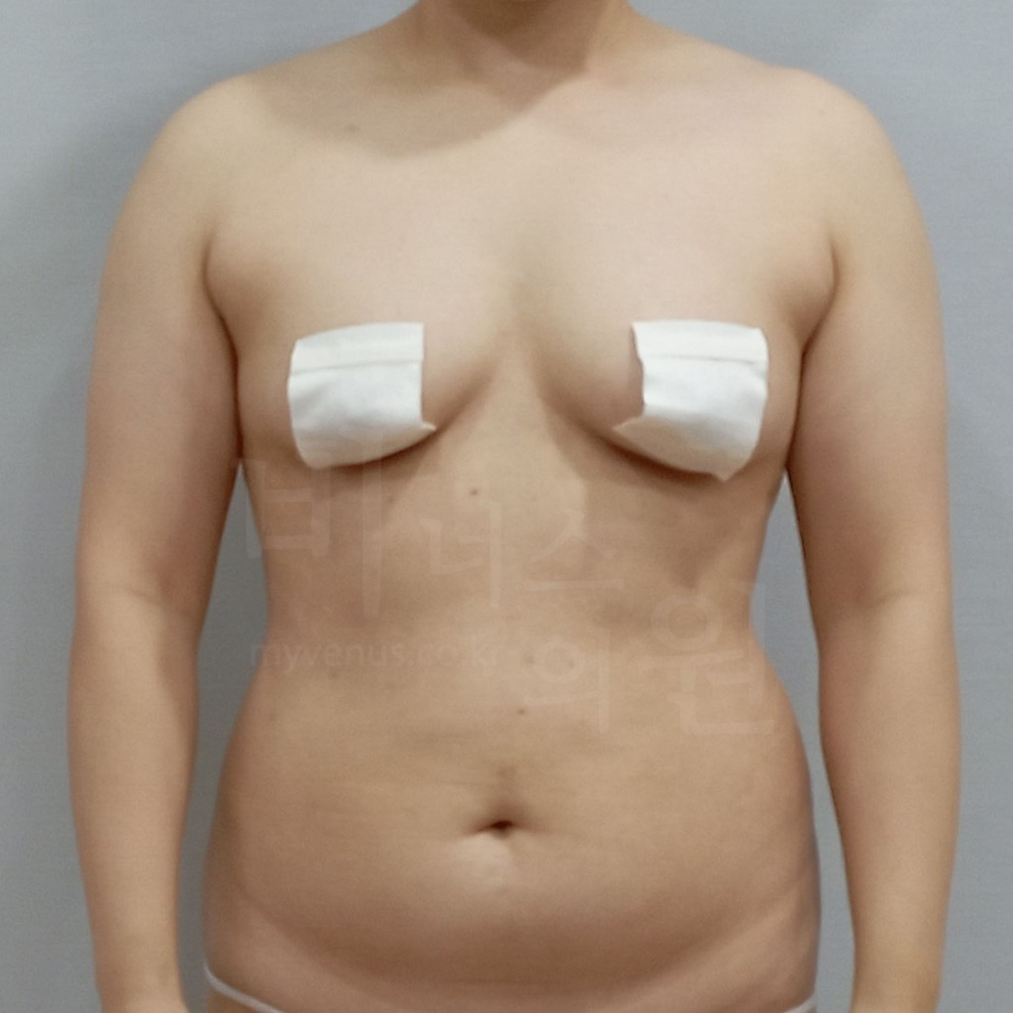 두껍고 불균형한 팔 뒤 라인.jpg