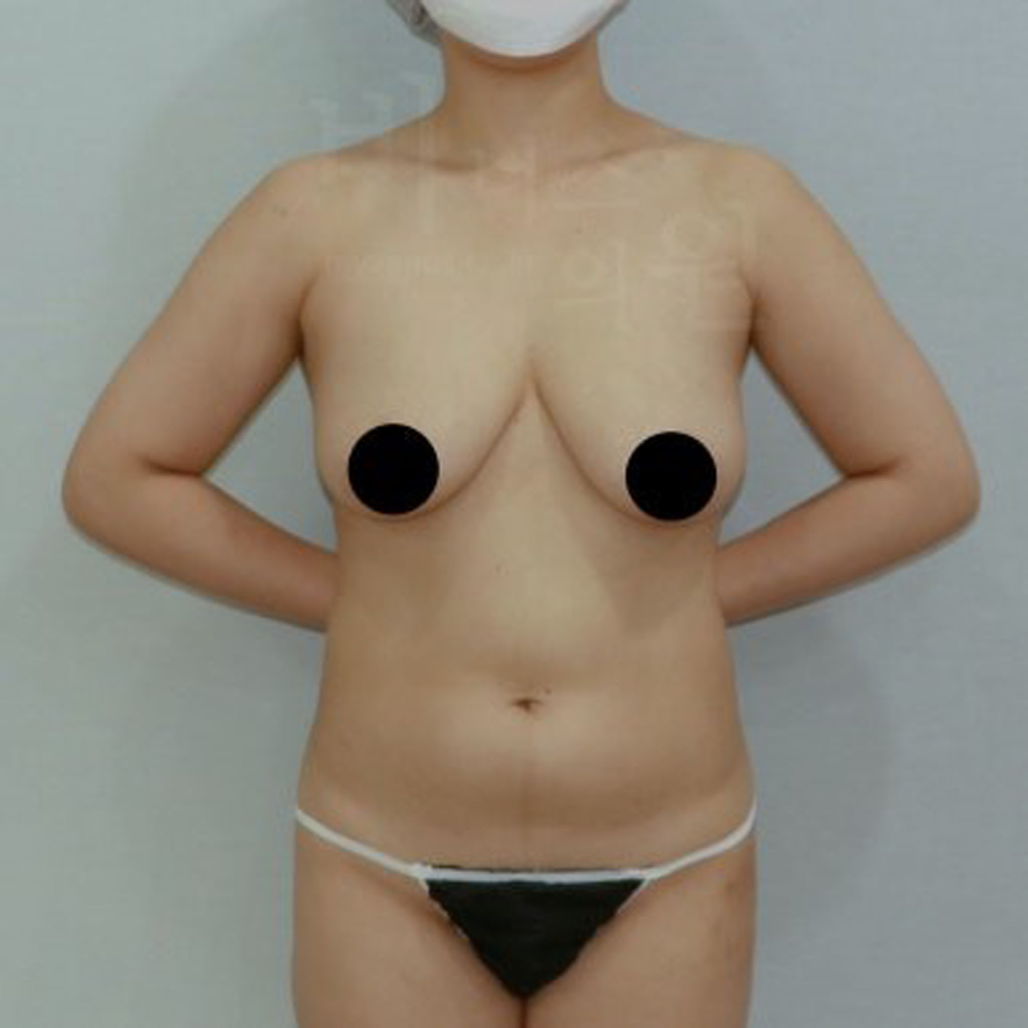 유방 주변 군살이 있는 모습.JPG