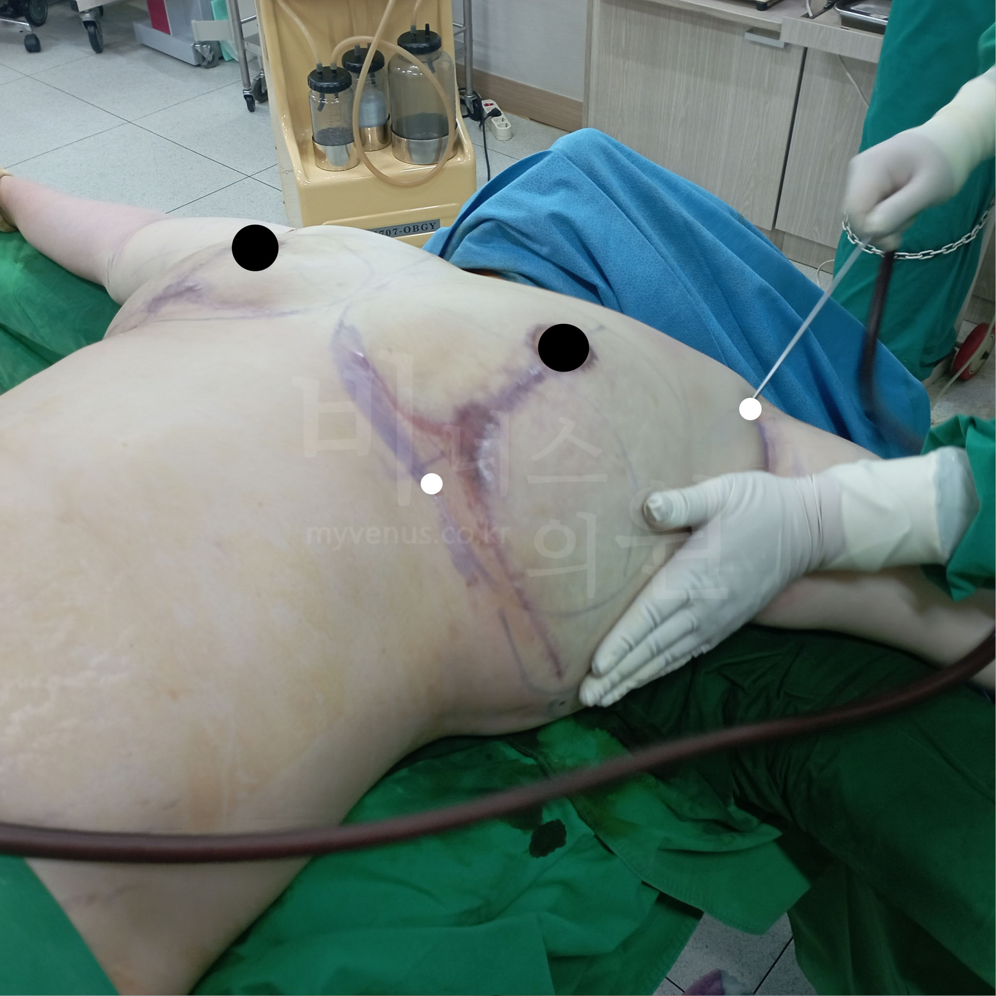 가슴 사이즈가 줄어들고 탄력 있는 모습.jpg