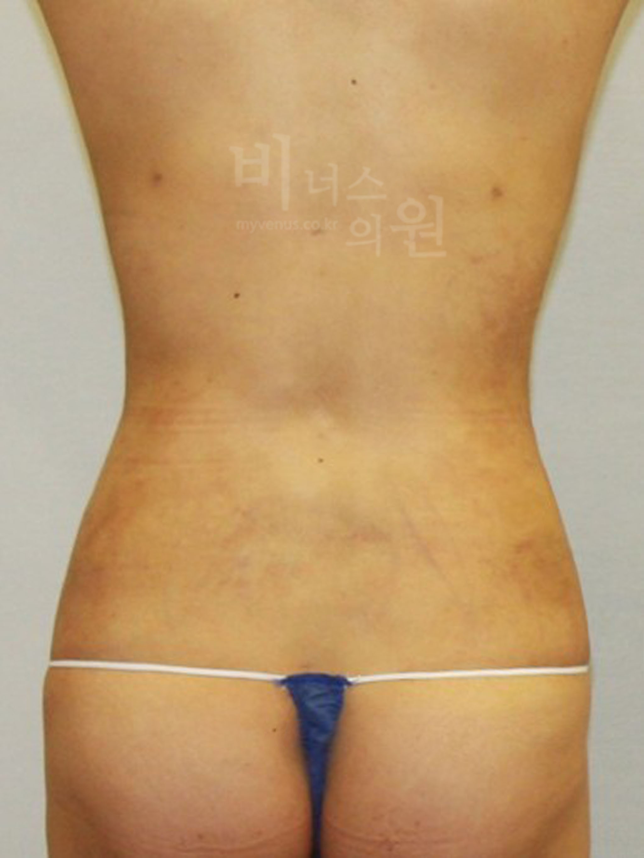 복부지방흡입 재수술 멍