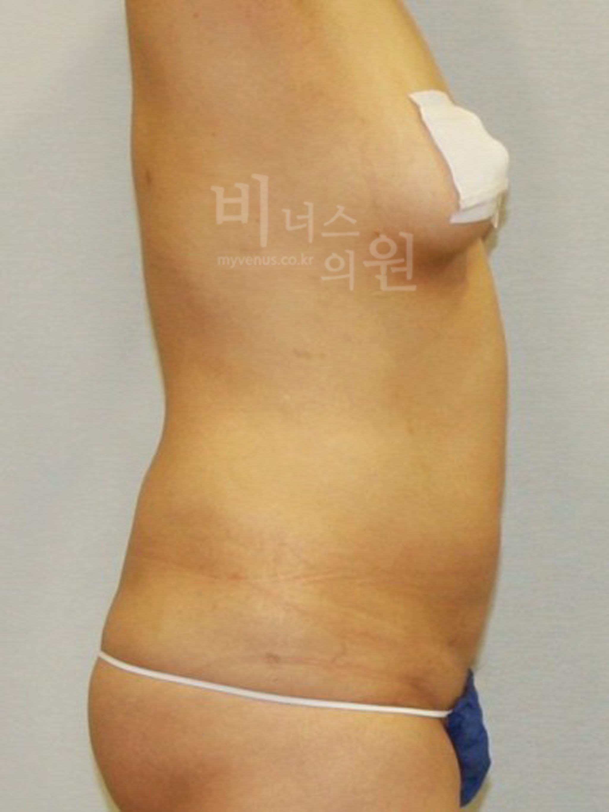 복부지방흡입 사진