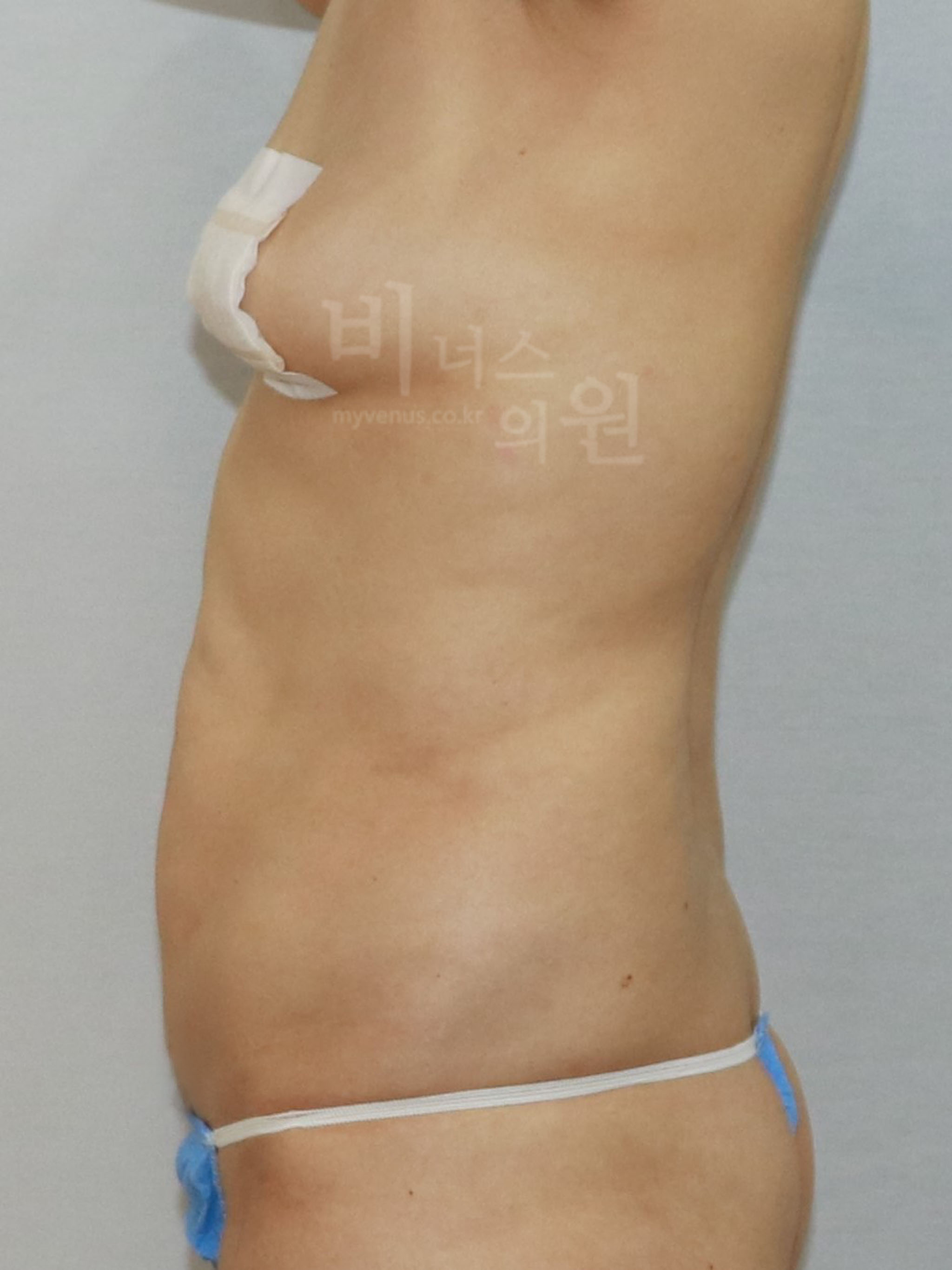 재수술 지방흡입