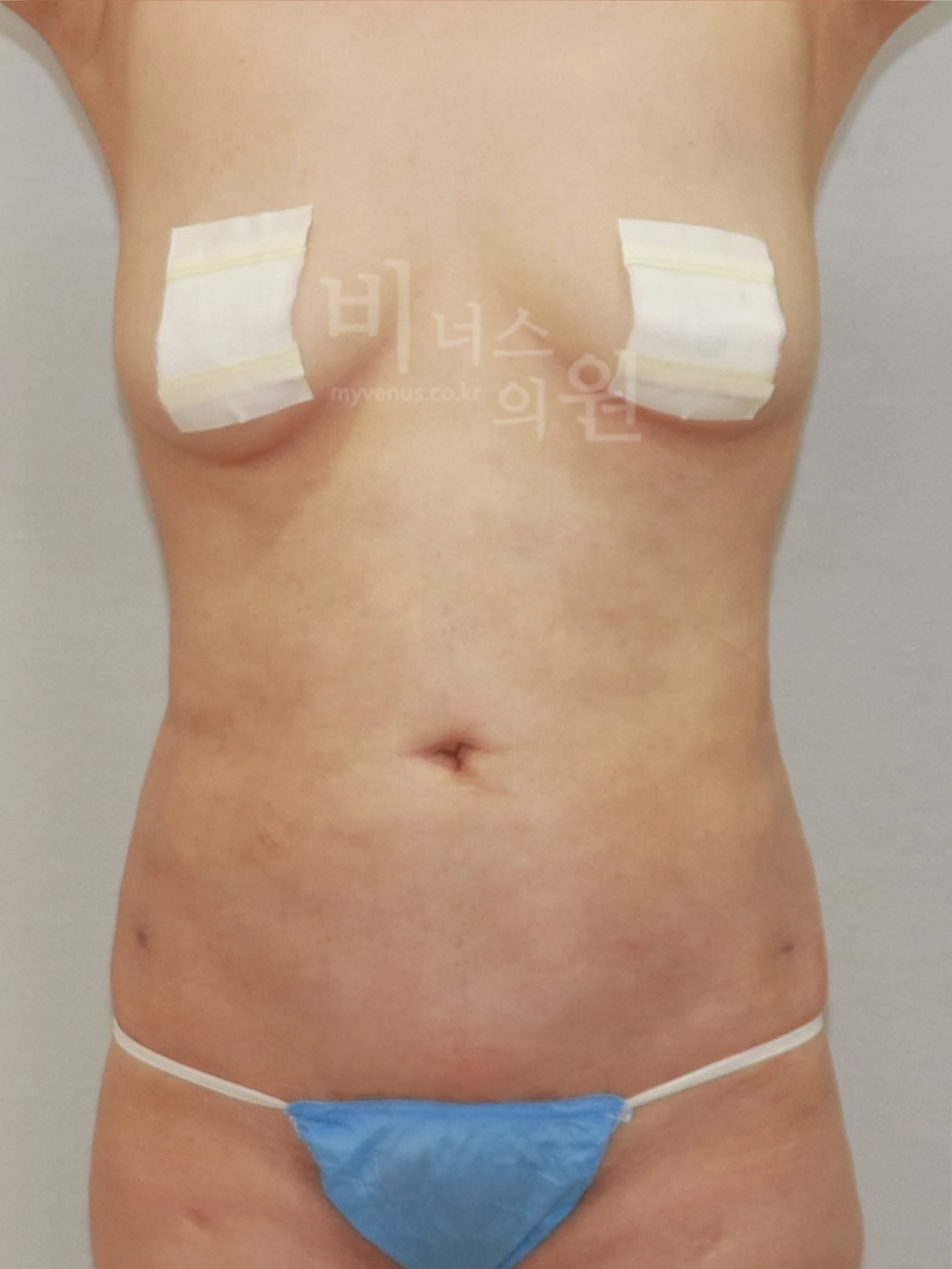 재수술 지방흡입