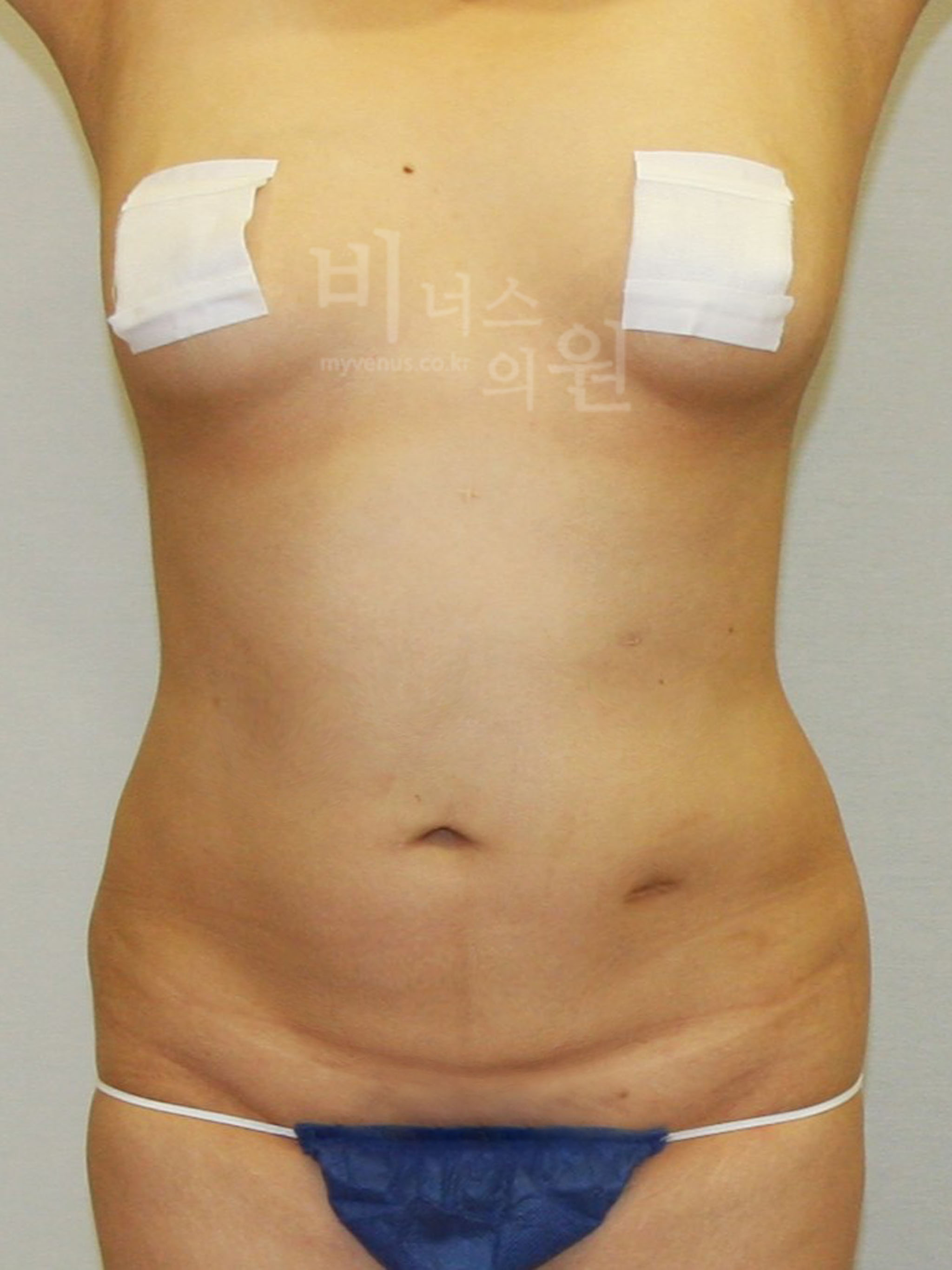 복부 재수술 지방흡입 전후 사진