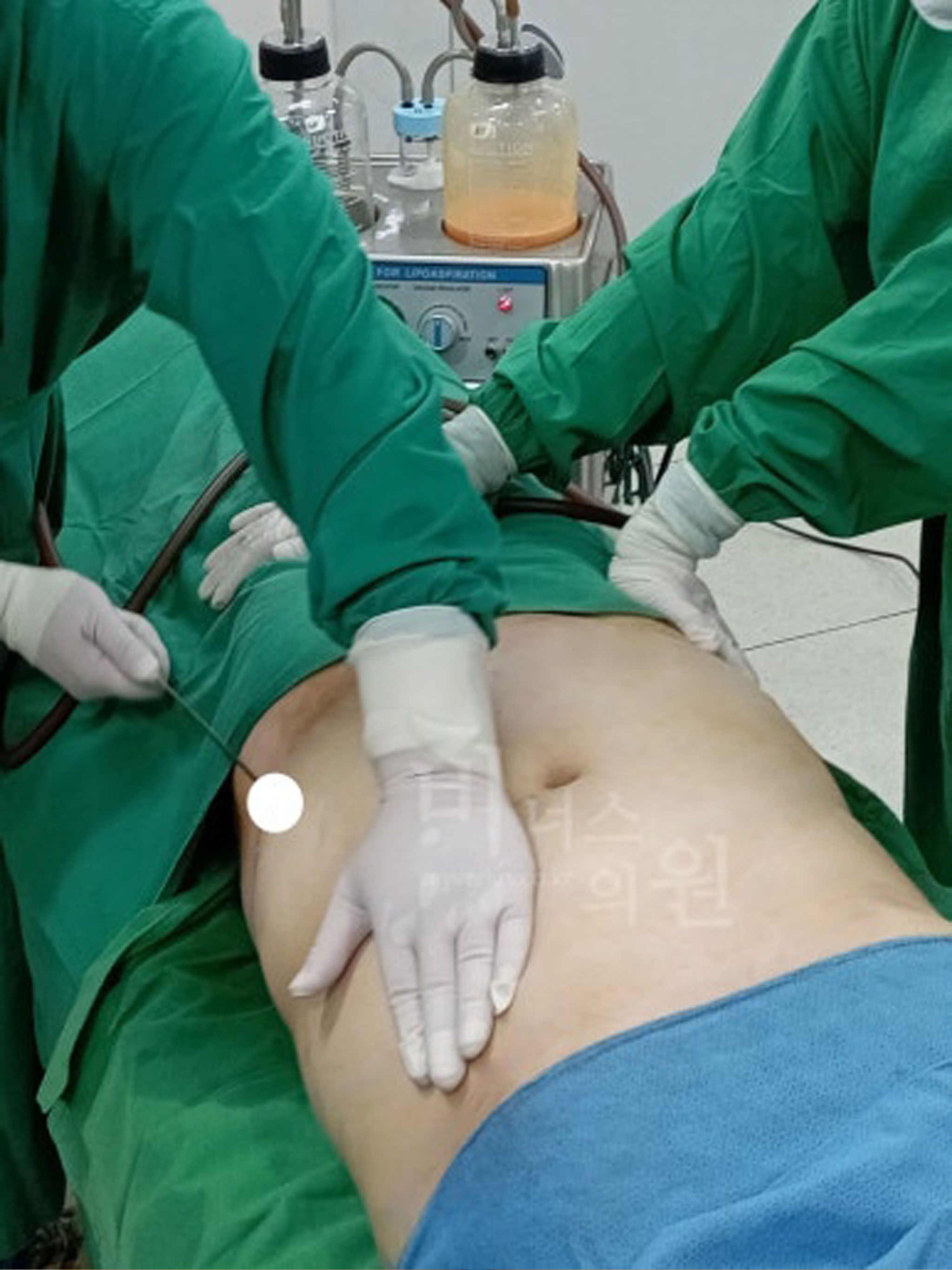 복부 재수술 지방흡입