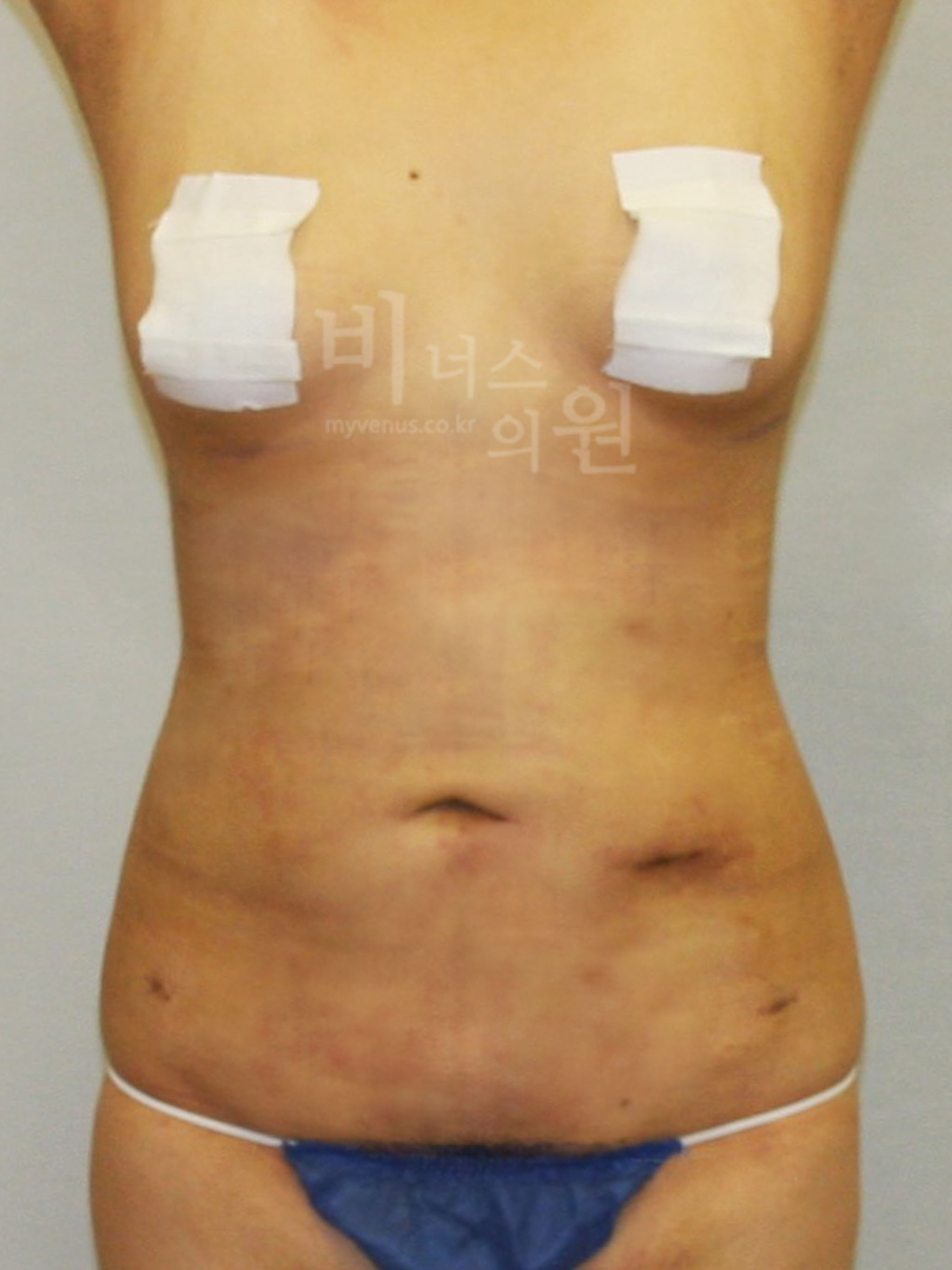 복부지방흡입 재수술 전후 사진