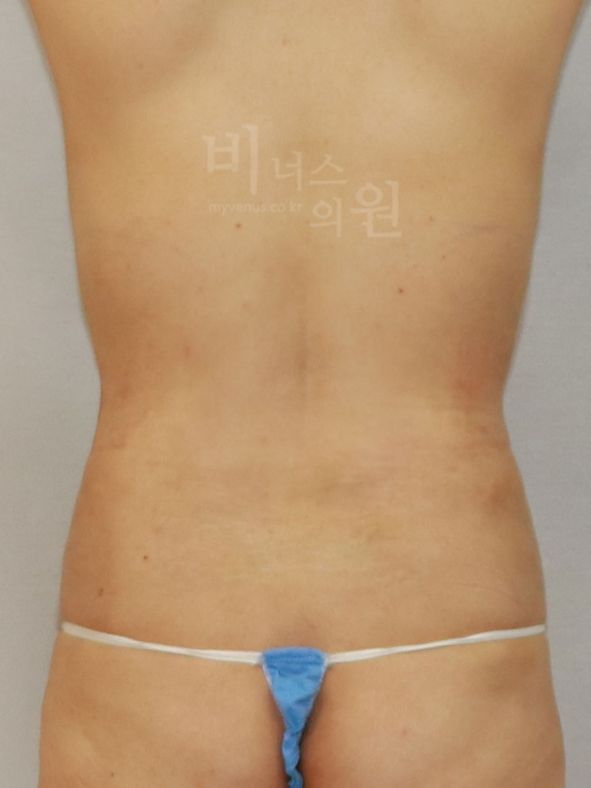 복부지방흡입 재수술