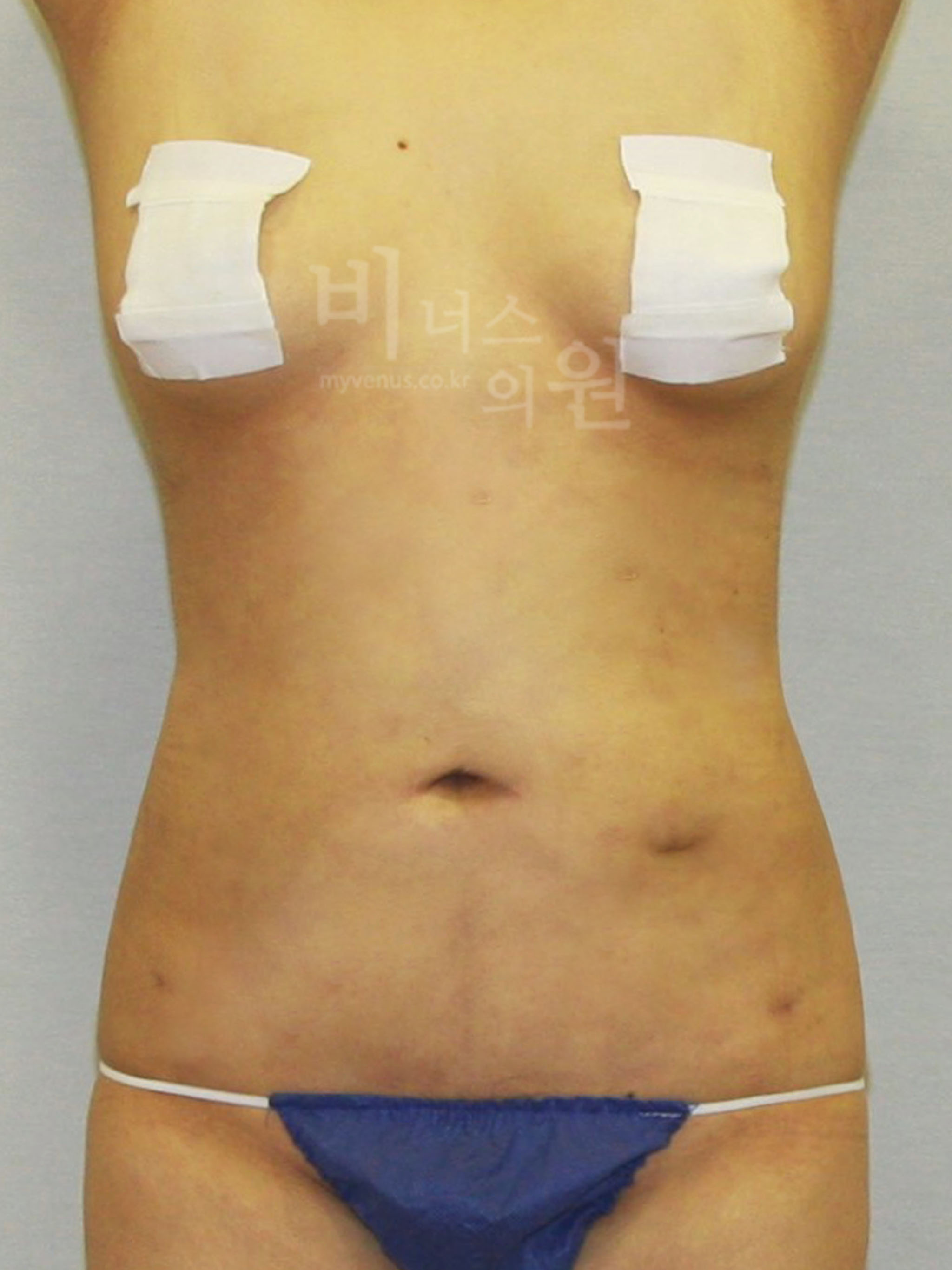 복부지방흡입 전후사진