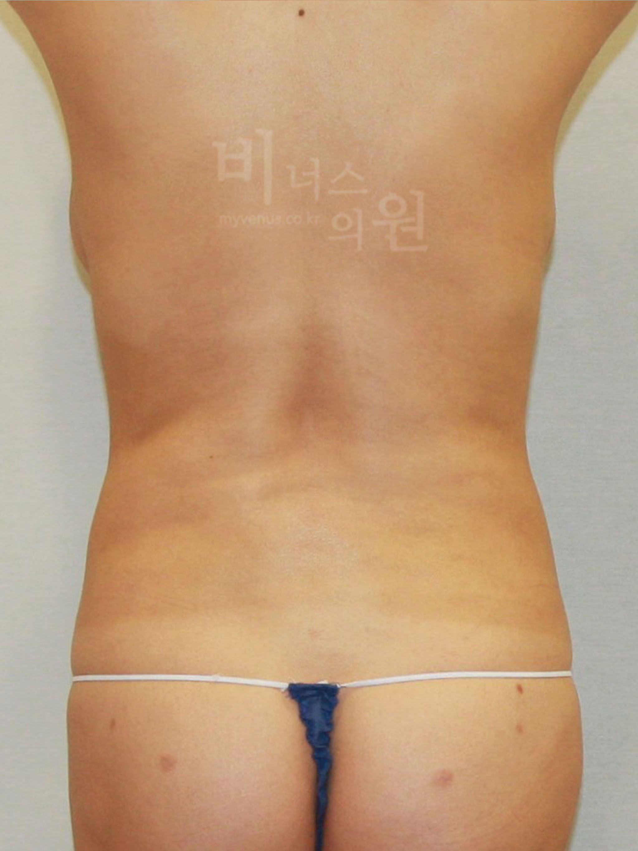 재수술 복부지방흡입