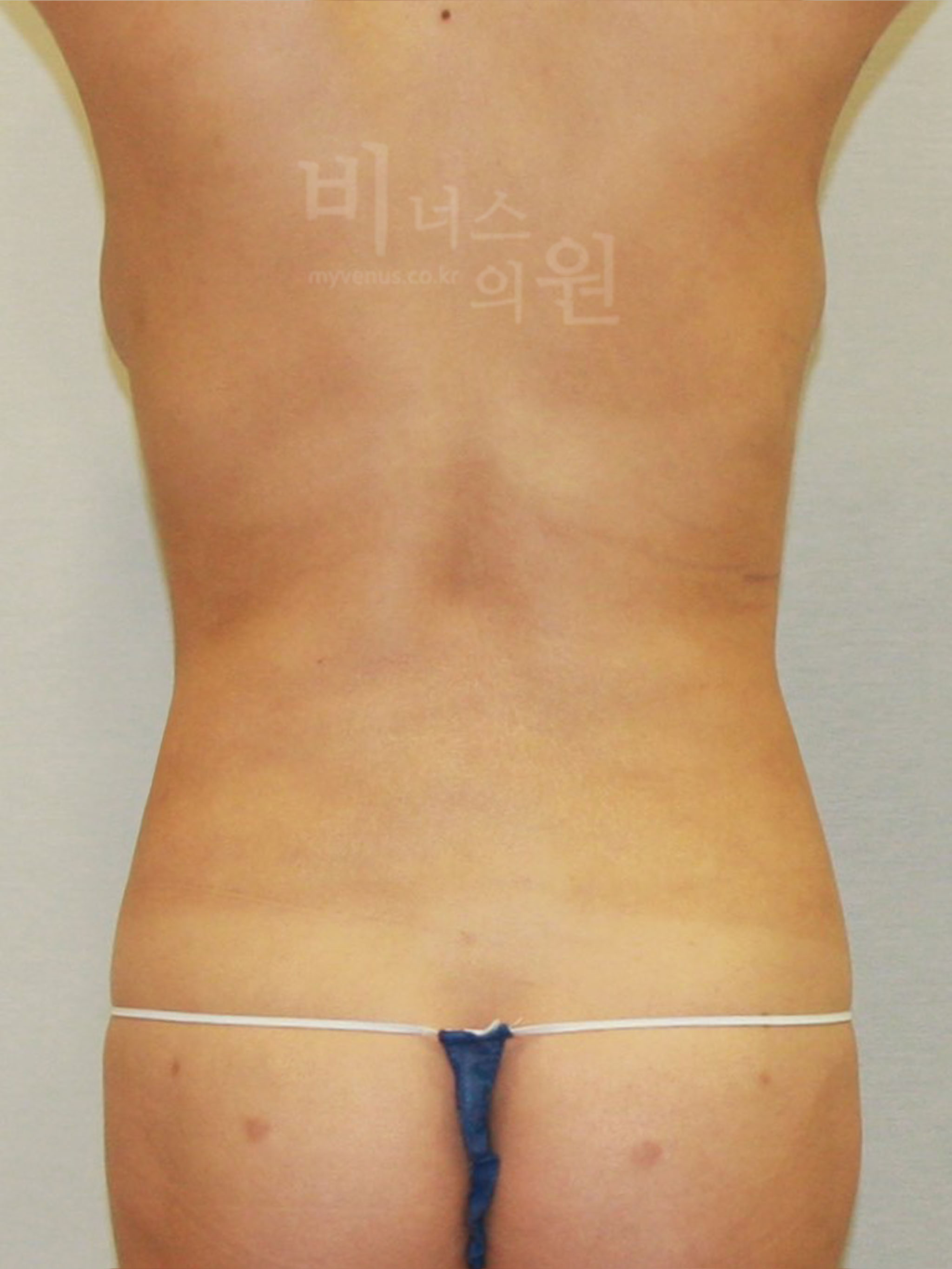 옆구리지방흡입