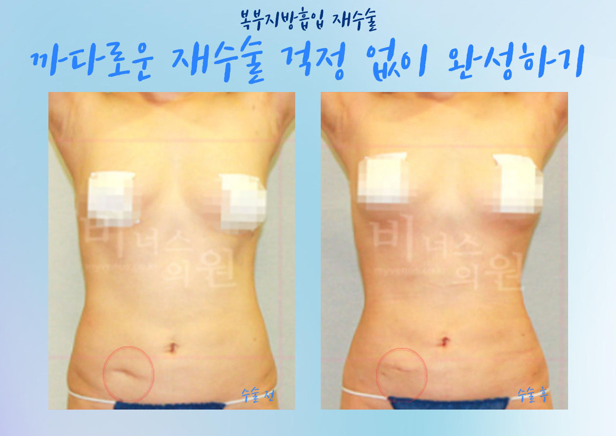 복부지방흡입 전후 사진