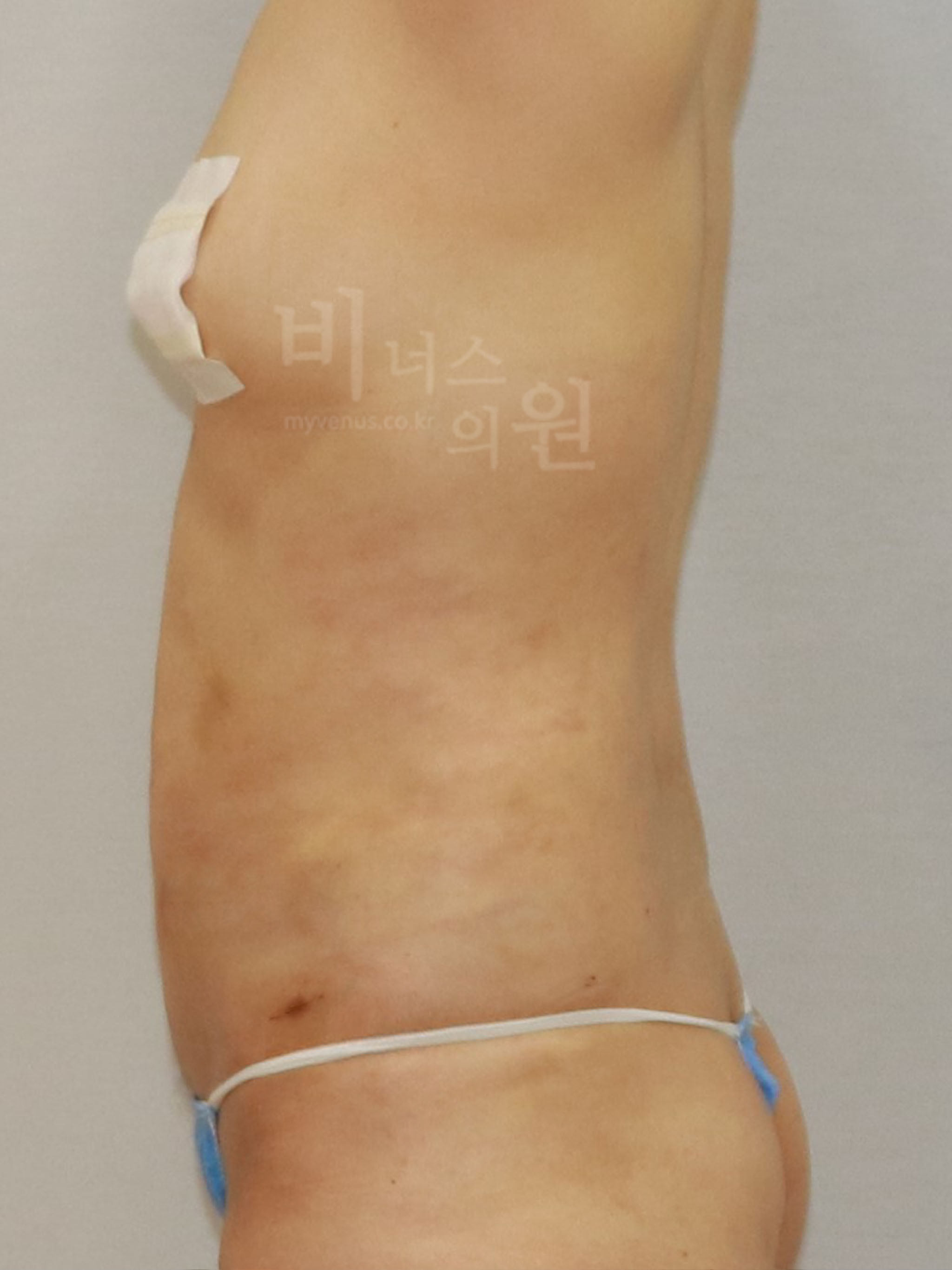 지방흡입 전후사진