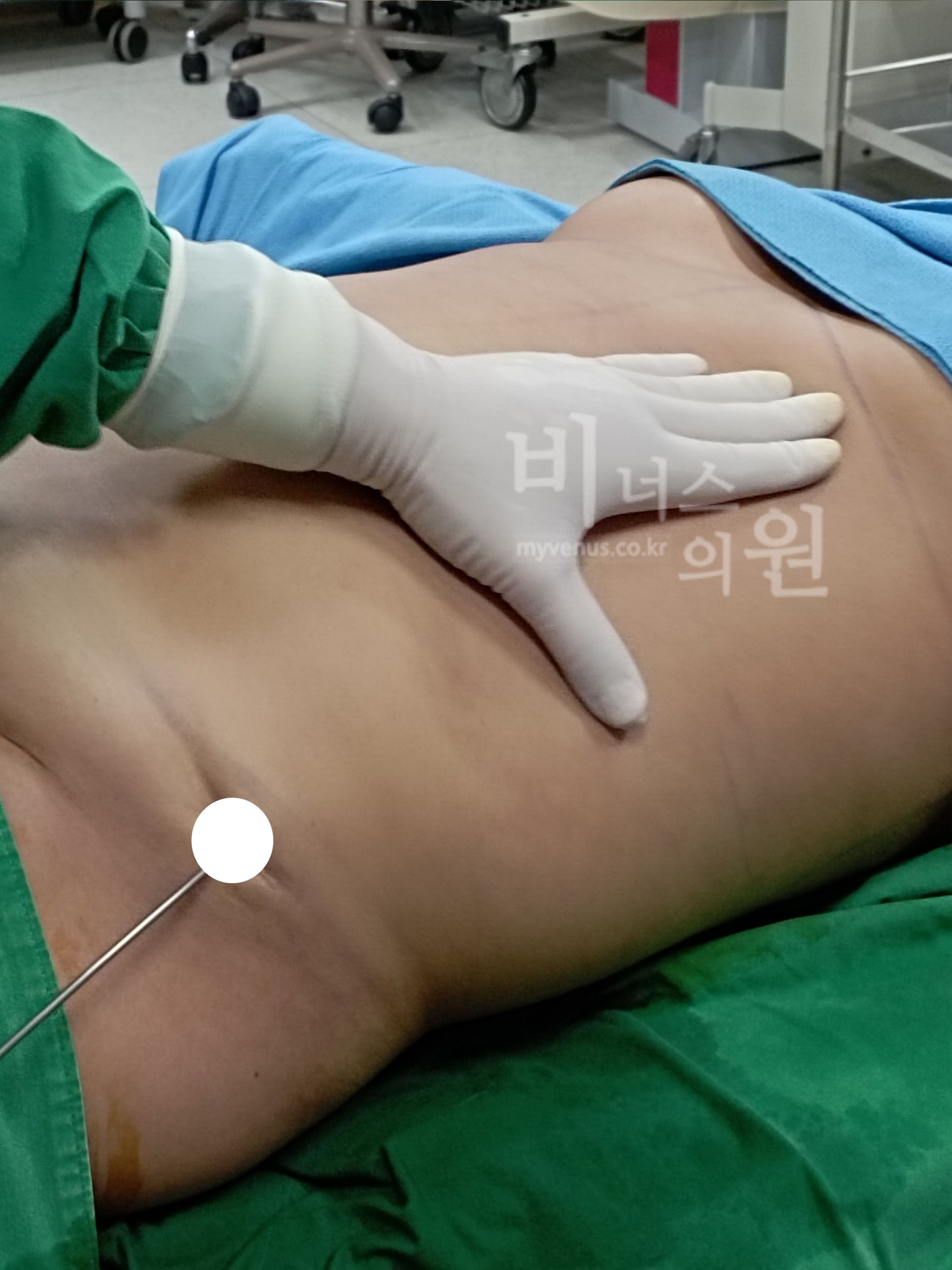 옆구리지방흡입