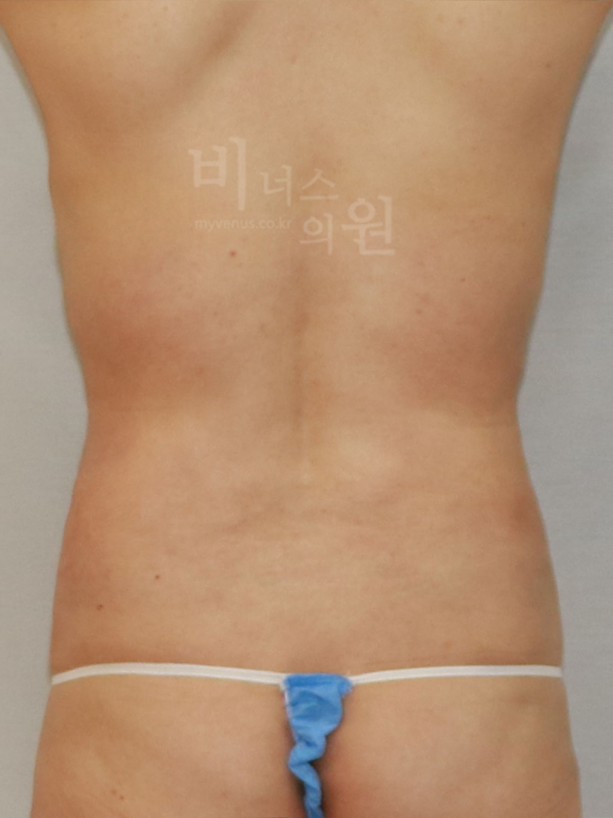 복부지방흡입 재수술