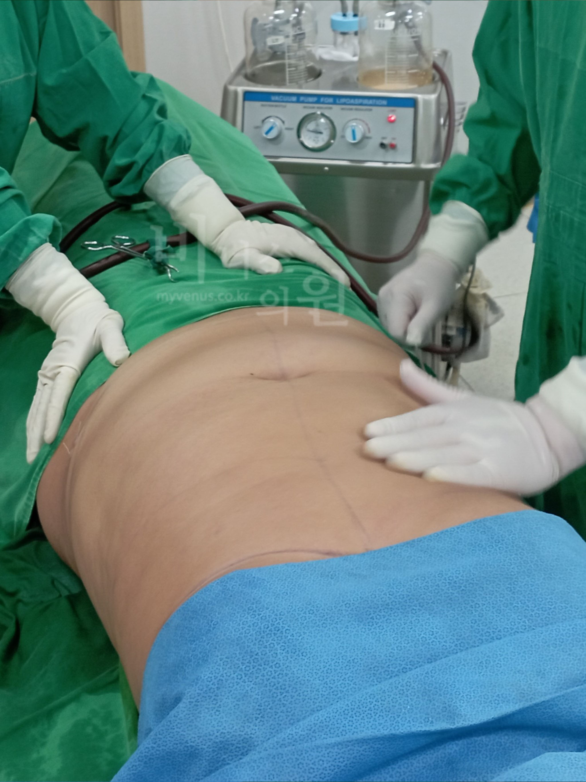 복부지방흡입 부작용