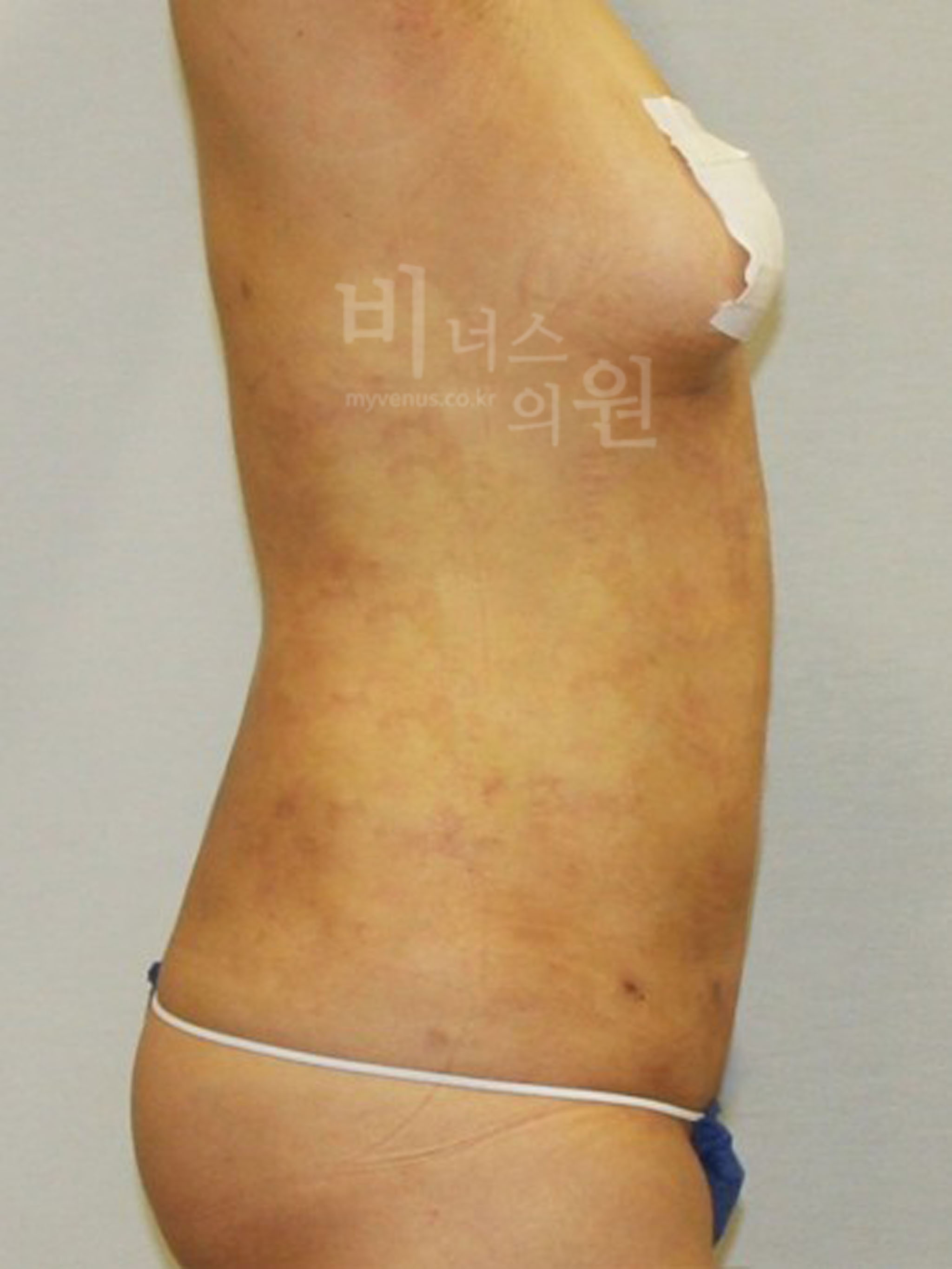 복부지방흡입 재수술 경과