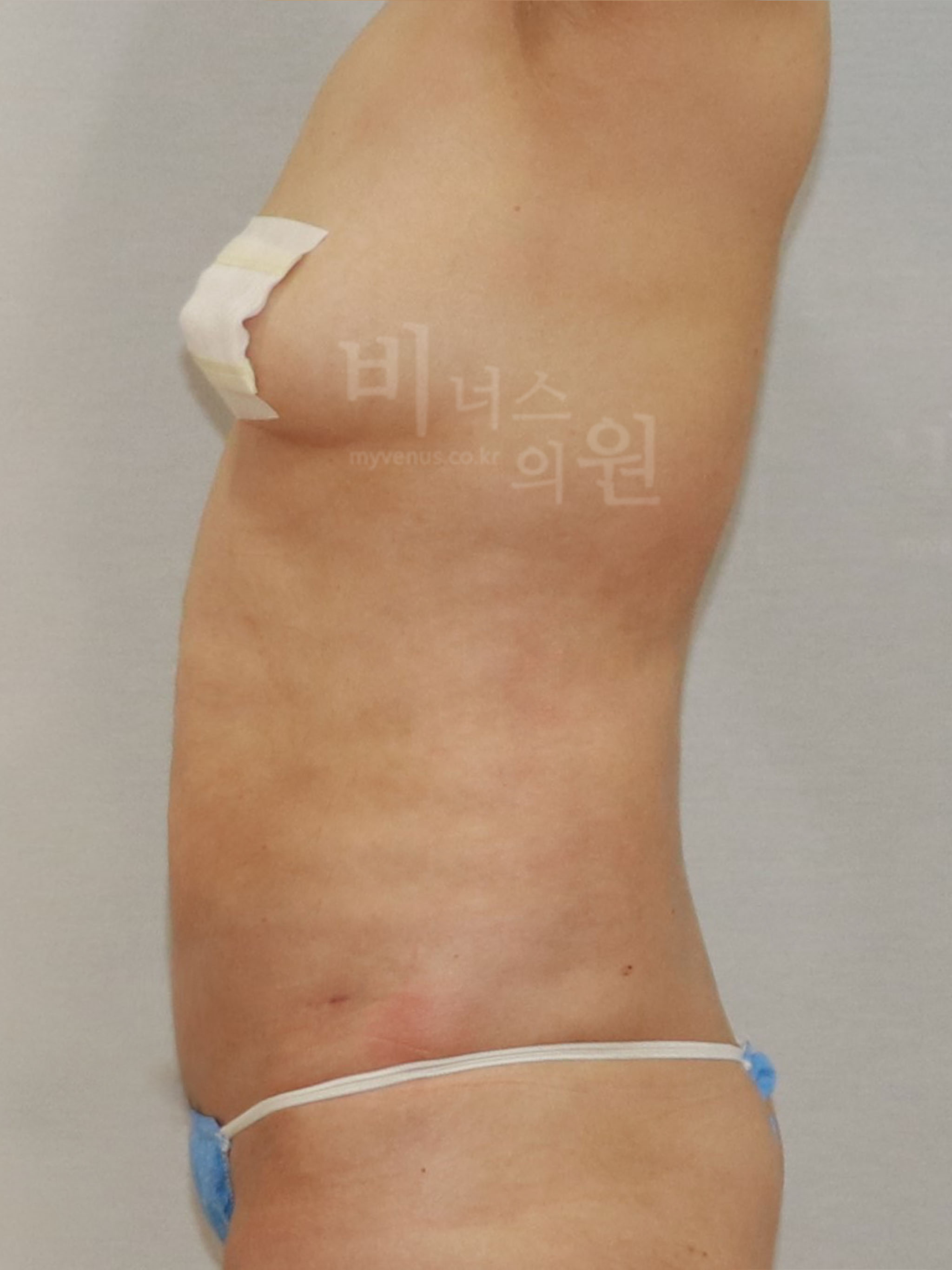 뒷구리지방흡입