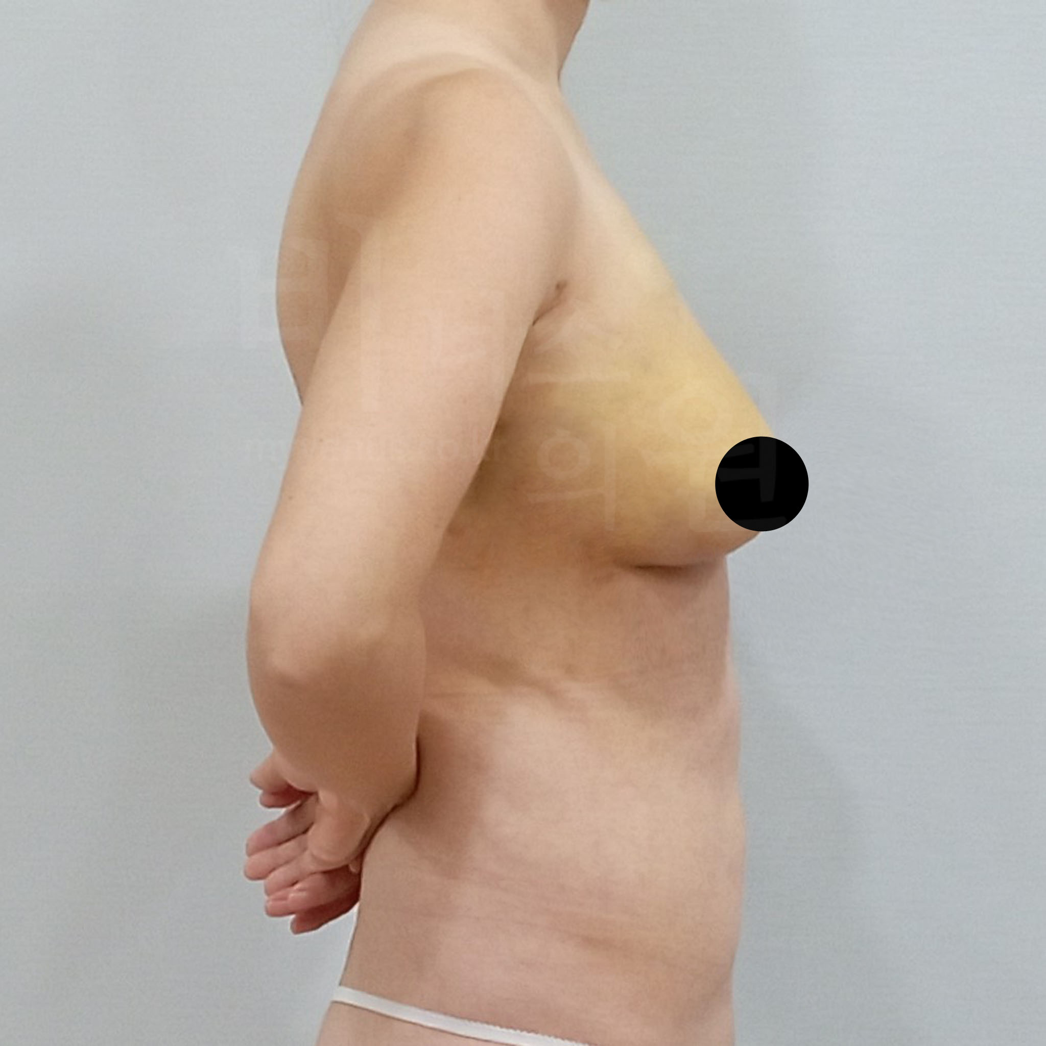 가슴성형 전후.jpg