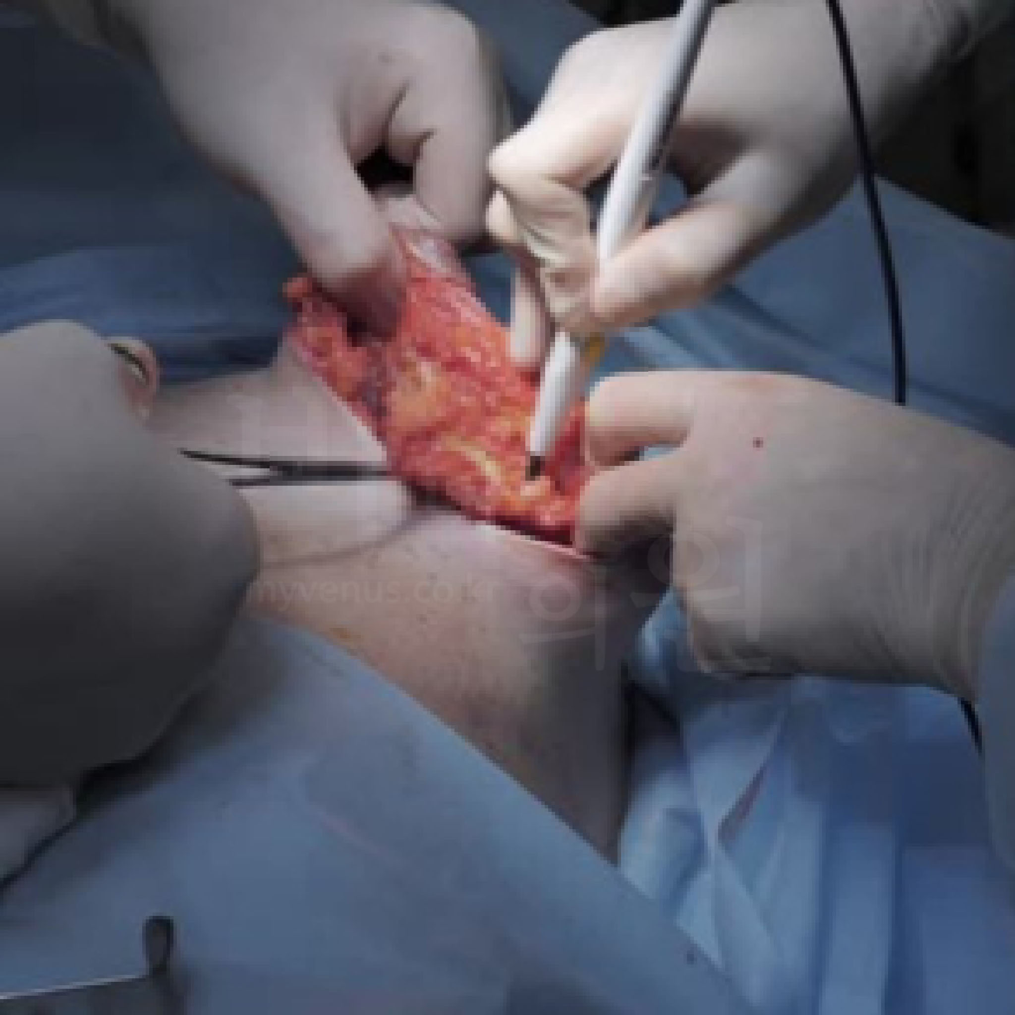 가슴축소 절제술.jpg