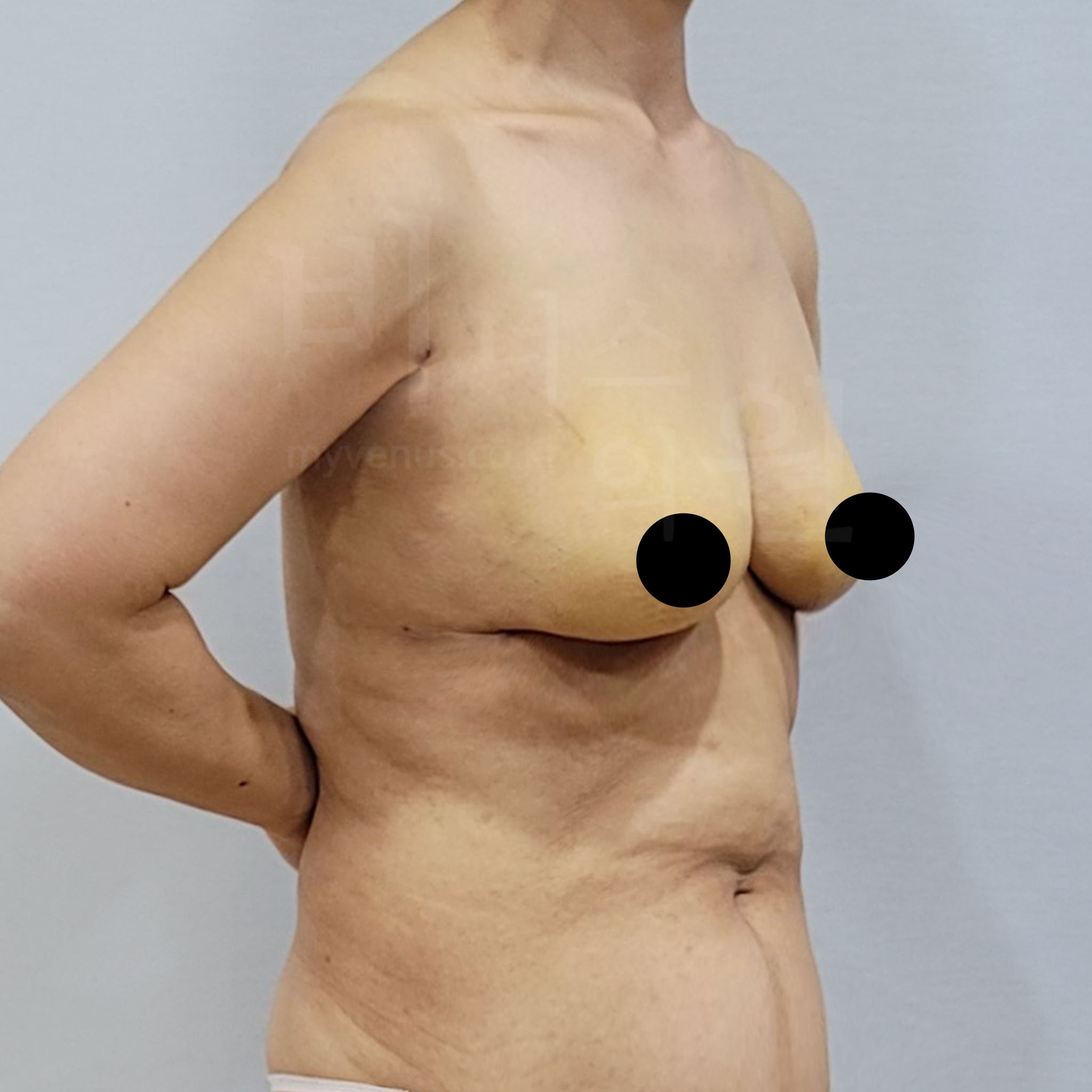 가슴 전후 흉터.jpg