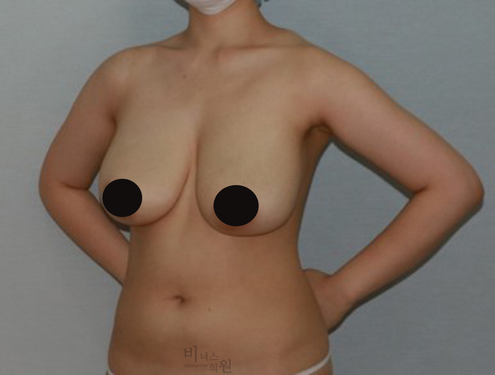 가슴축소지방흡입11.jpg