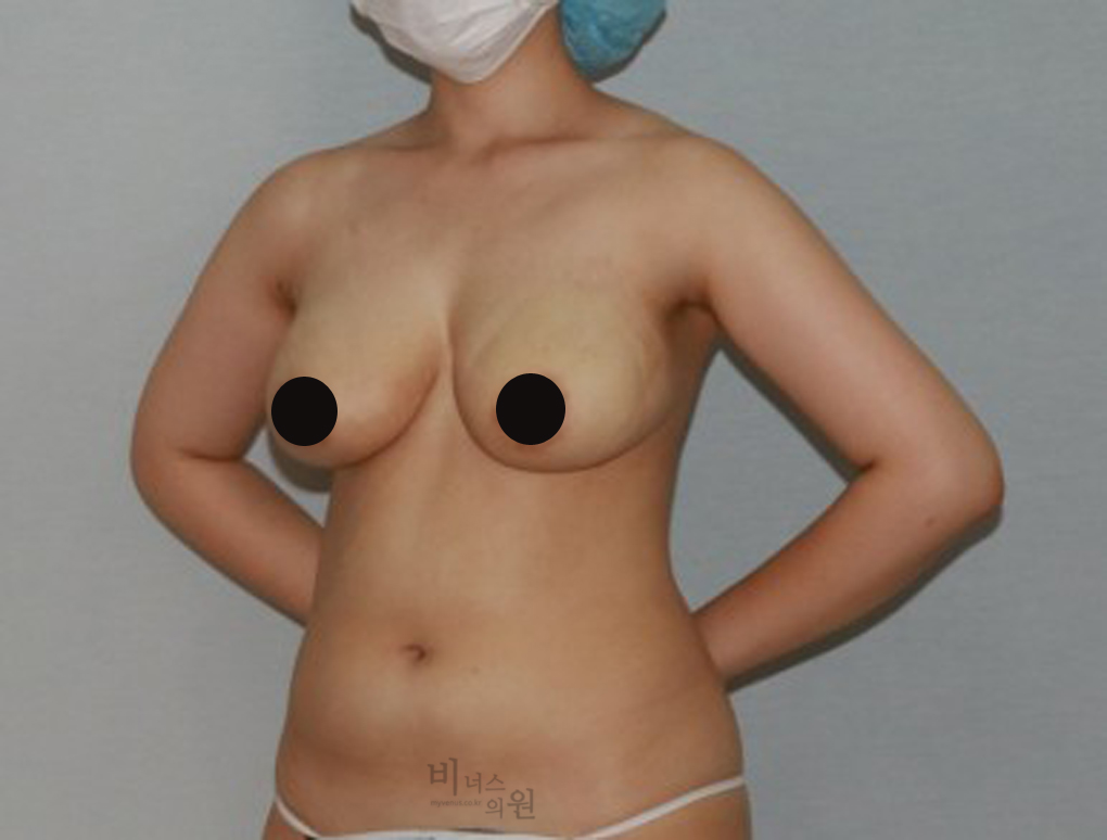 가슴축소지방흡입12.jpg