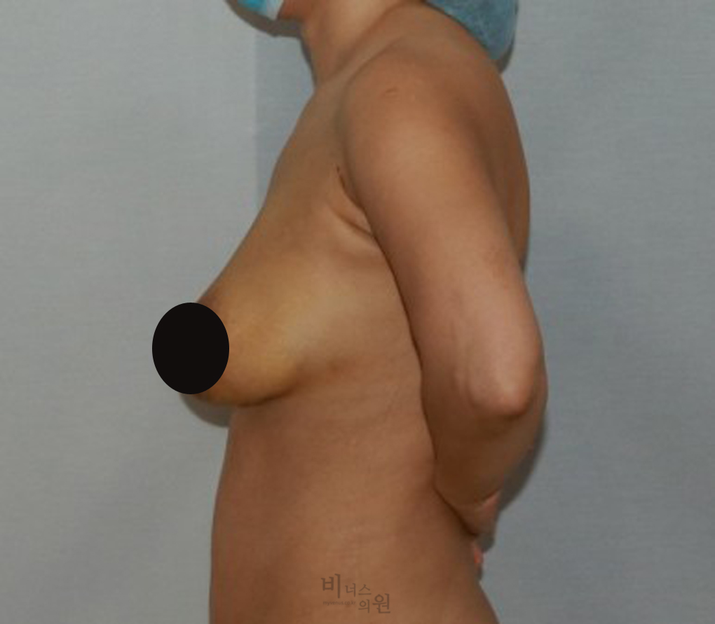 가슴축소지방흡입16.jpg