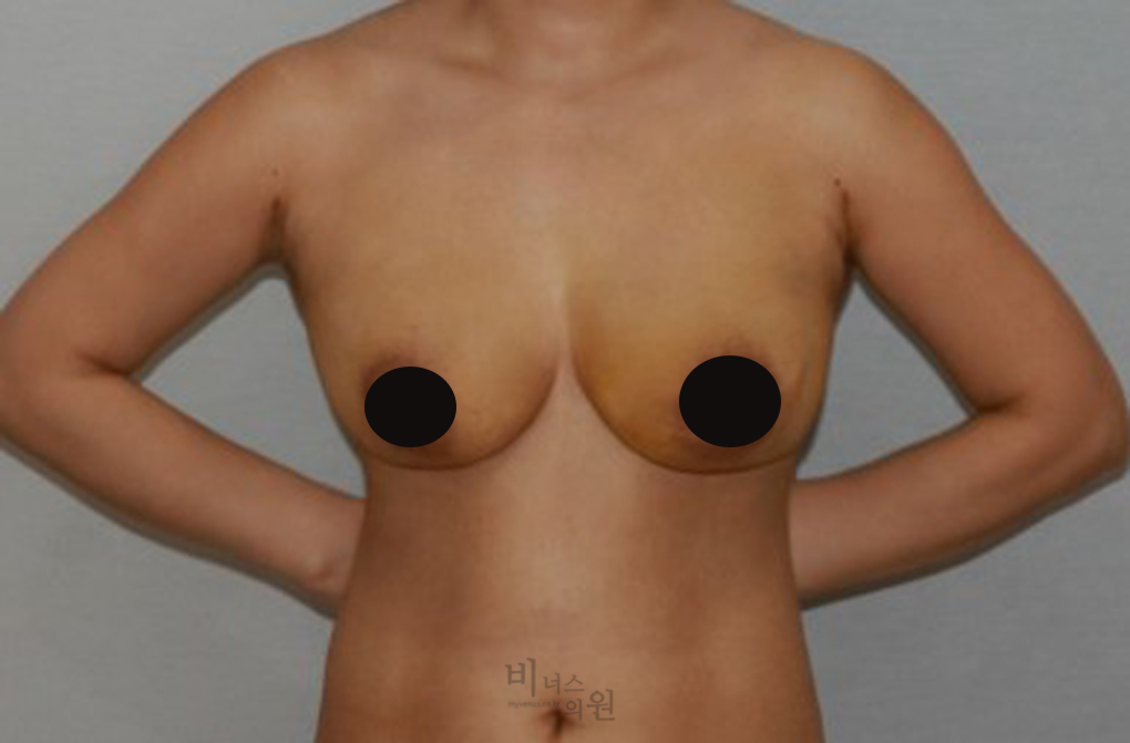 가슴축소지방흡입14.jpg