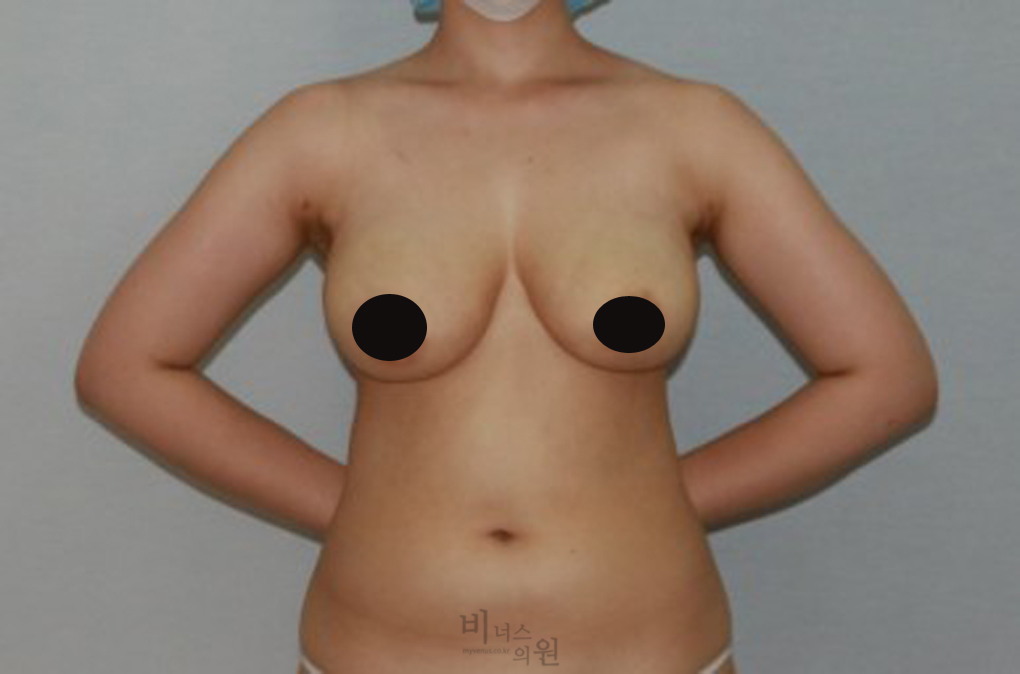 가슴축소지방흡입8.jpg