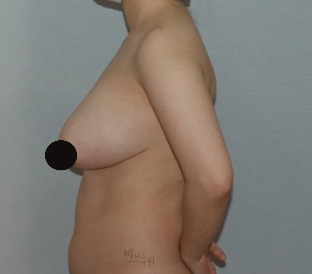 가슴축소지방흡입3.jpg