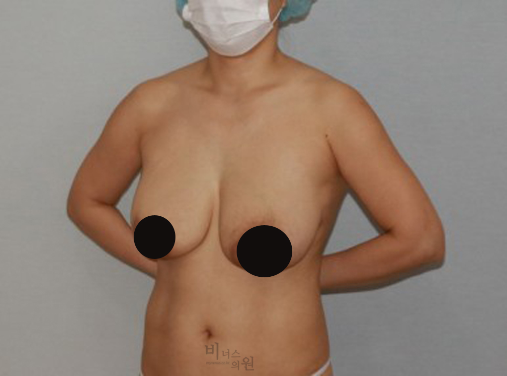 가슴축소지방흡입17.jpg