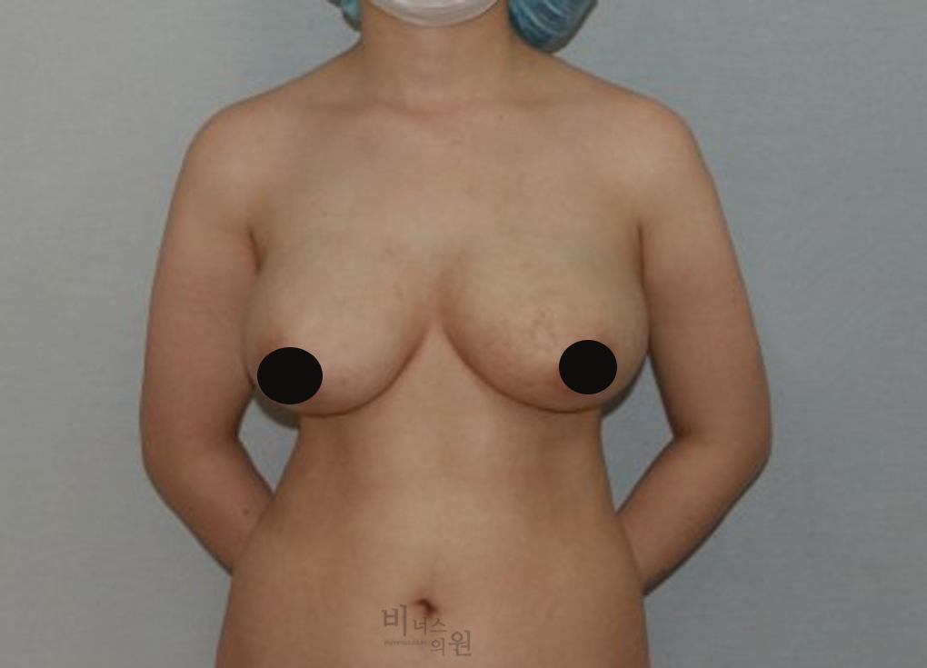 가슴축소지방흡입2.jpg