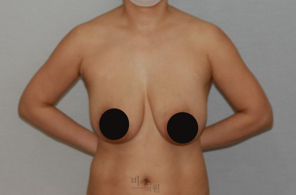 가슴축소지방흡입13.jpg