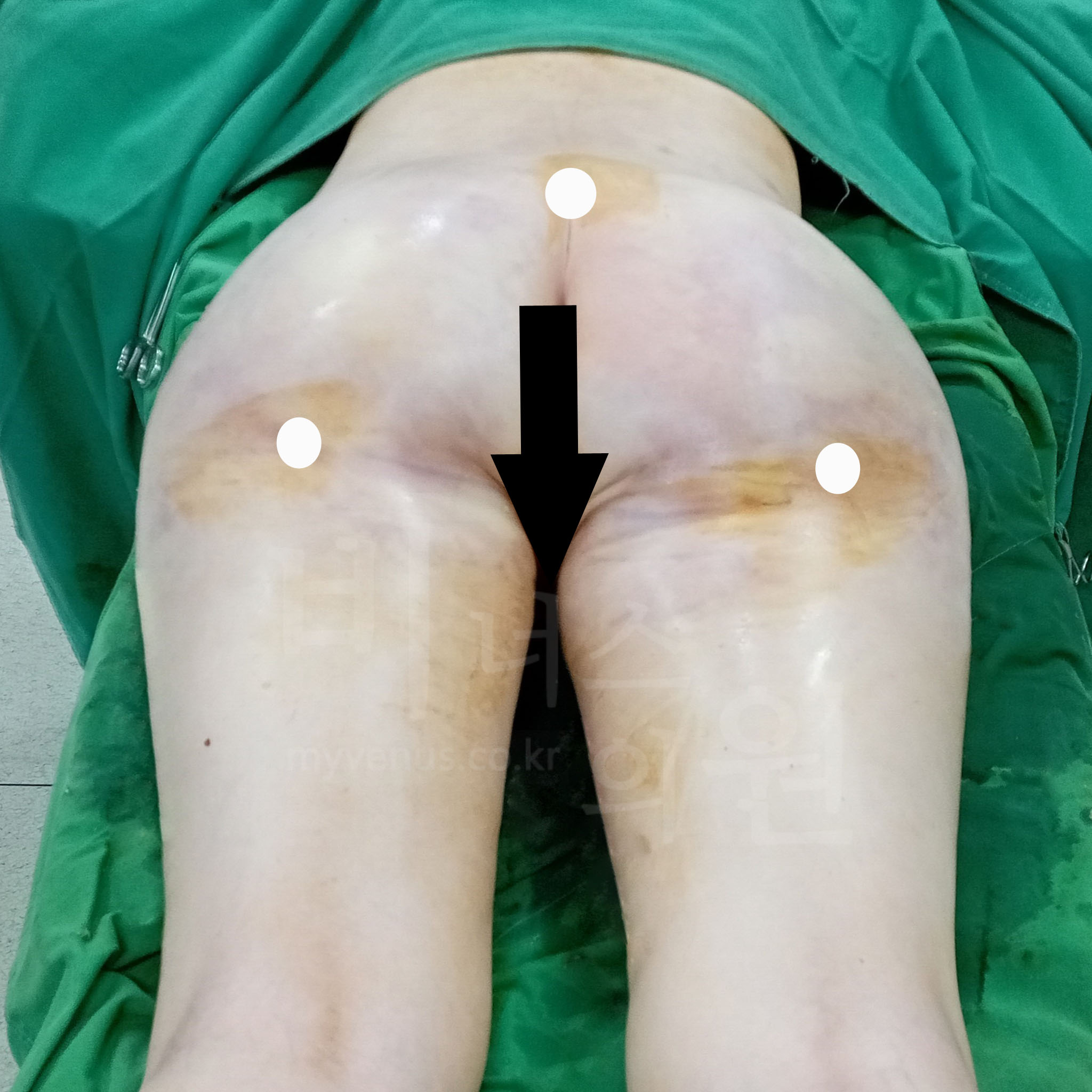 허벅지 바깥살이 정리된 옆태.jpg