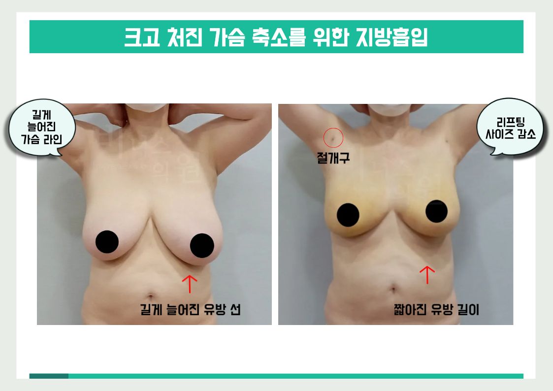 가슴축소.jpg