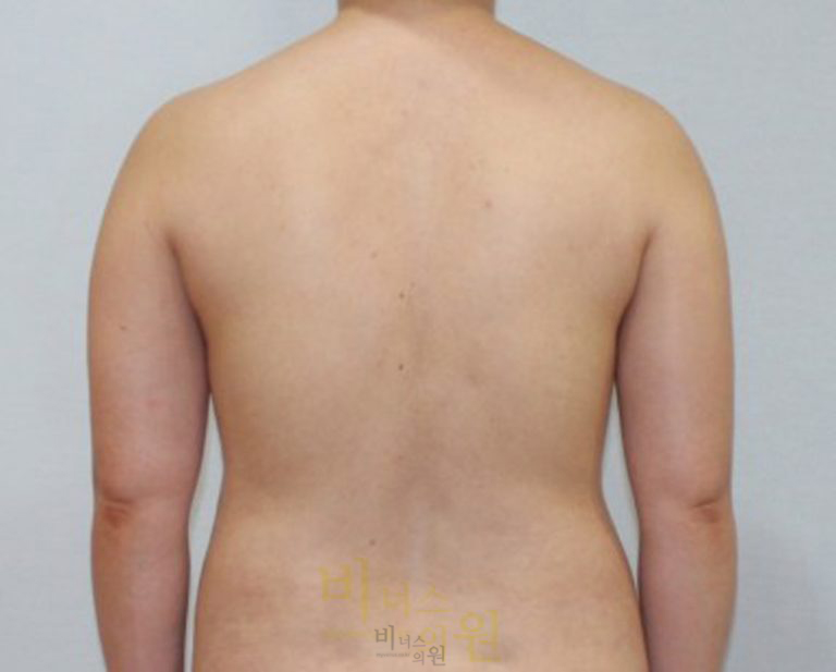 팔뚝지방흡입5.jpg
