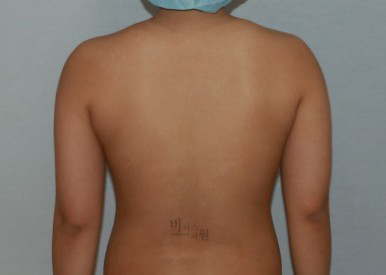 팔뚝지방흡입17.jpg